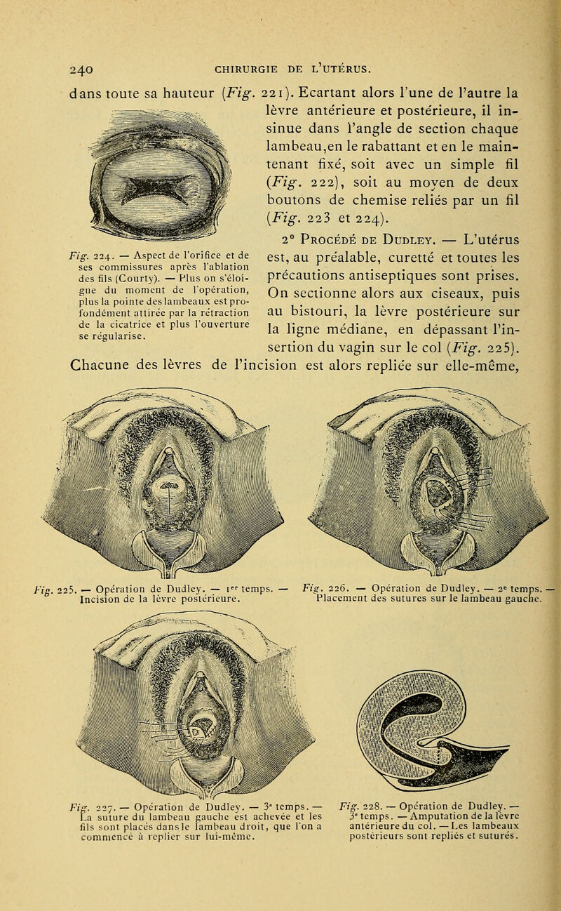 dans toute sa hauteur [Fig. 221). Ecartant alors l'une de l'autre la lèvre antérieure et postérieure, il in- sinue dans l'angle de section chaque lambeau,en le rabattant et en le main- tenant fixé, soit avec un simple fil {Fig. 222), soit au moyen de deux boutons de chemise reliés par un fil [Fig. 22 3 et 224). 20 Procédé de Dudley. — L'utérus est, au préalable, curette et toutes les précautions antiseptiques sont prises. On sectionne alors aux ciseaux, puis au bistouri, la lèvre postérieure sur la ligne médiane, en dépassant l'in- sertion du vagin sur le col [Fig. 225). Chacune des lèvres de l'incision est alors repliée sur elle-même, Fig. 224. — Aspect de l'orifice et de ses commissures après l'ablation des fils (Courty). — Plus on s'éloi- gne du moment de l'opération, plus la pointe des lambeaux est pro- fondément attirée par la rétraction de la cicatrice et plus l'ouverture se régularise. '■ ' ■v-#: /& i 1 ■ . ' ':.:■ y msr Fis. 225. — Opération de Dudley. — 1er temps. — Fig. 226. — Opération de Dudley. — 2e temps. — Incision de la lèvre postérieure. Placement des sutures sur le lambeau gauche. Fig. 227. — Opération de Dudley. — 3e temps. — La suture du lambeau gauche est achevée et les fils sont placés dans le lambeau droit, que l'on a commencé à replier sur lui-même. Fig. 228. — Opération de Dudley. — 3° temps. —Amputation de la lèvre antérieure du col. — Les lambeaux postérieurs sont repliés et suturés.