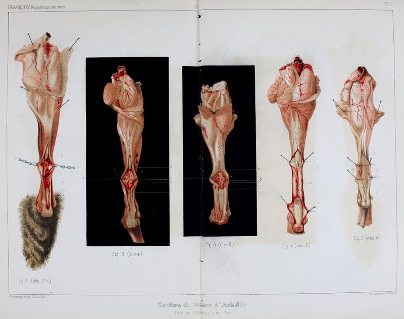 Pli ? i r 1 (obs.N°l) Duriarqua\f priFj) Cassai iid fig. 2 (obs,^) fig. 3 (obs- 5 fig. 4 (obs. 6) fi(i..5 (obs. 8 JM.Chlîsscb Strasiourç Publie, par J B Bailhorp r( fVlr a F,in.<^