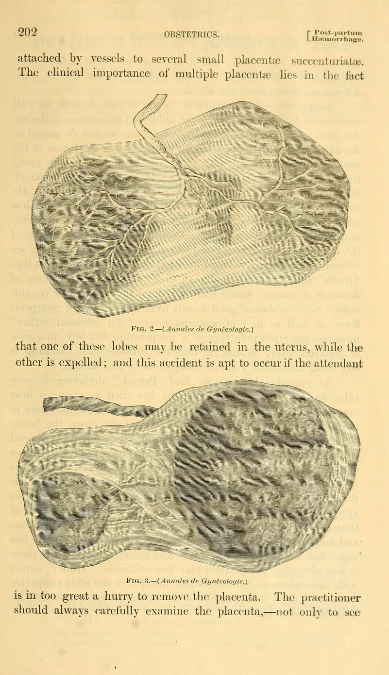 202 OBSTETRICS. r Post-partum LHpBmorrliaKe. attached by vessels to several small placentEe succcnturiatse. The clmical importance of multiple placentae lies in the fact Fig. 2.—{Annates de Gynecologie.) that one of these lobes may be retained in the uterus, while the other is expelled; and this accident is apt to occur if the attendant Fig. 3.—{Annales de Gynecologie.) IS m ^^ ... too great a hurry to remove the placenta. The practitioner should always carefully examine the placenta,—not only to see