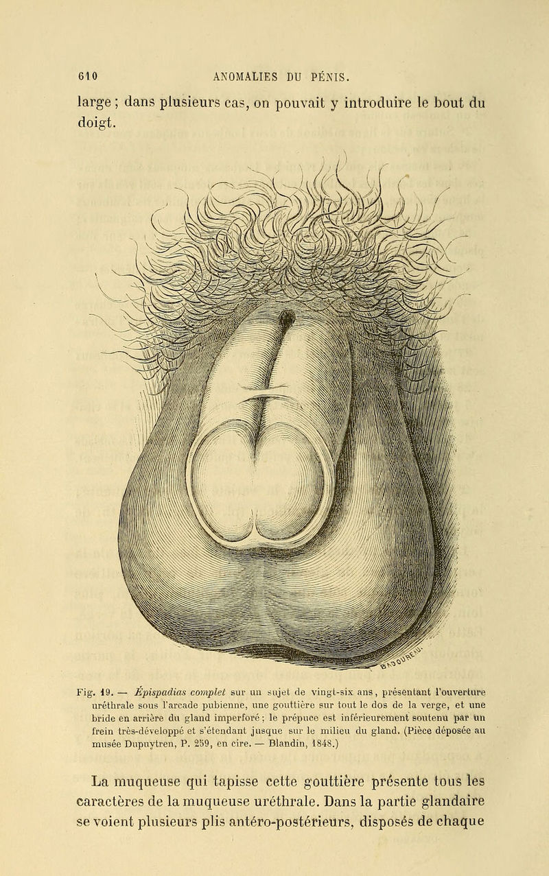 large ; dans plusieurs cas, on pouvait y introduire le bout du doigt. Fig. 19. — Épispadias complet sur un sujet de vingt-six ans, présentant l'ouverture uréthrale sous l'arcade pubienne, une gouttière sur tout le dos de la verge, et une bride en arrière du gland imperforé ; le prépuce est intérieurement soutenu par un frein très-développé et s'étendant jusque sur le milieu du gland. (Pièce déposée au musée Dupuytren, P. 259, en cire. — Blandin, 1848.) La muqueuse qui tapisse cette gouttière présente tous les caractères de la muqueuse uréthrale. Dans la partie glandaire se voient plusieurs plis antéro-postérieurs, disposés de chaque