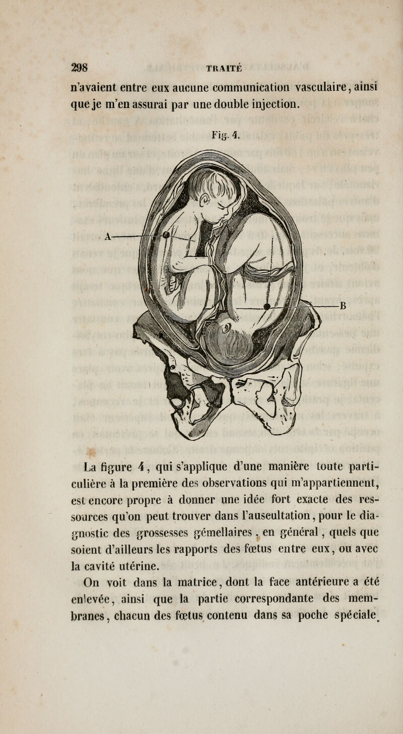 n'avaient entre eux aucune communication vasculaire, ainsi que je m'en assurai par une double injection. Fis- 4. La figure 4, qui s'applique d'une manière toute parti- culière à la première des observations qui m'appartiennent, est encore propre à donner une idée fort exacte des res- sources qu'on peut trouver dans l'auscultation, pour le dia- gaostic des grossesses gémellaires, en général, quels que soient d'ailleurs les rapports des fœtus entre eux, ou avec la cavité utérine. On voit dans la matrice, dont la face antérieure a été enlevée, ainsi que la partie correspondante des mem- branes, chacun des fœtus contenu dans sa poche spéciale^