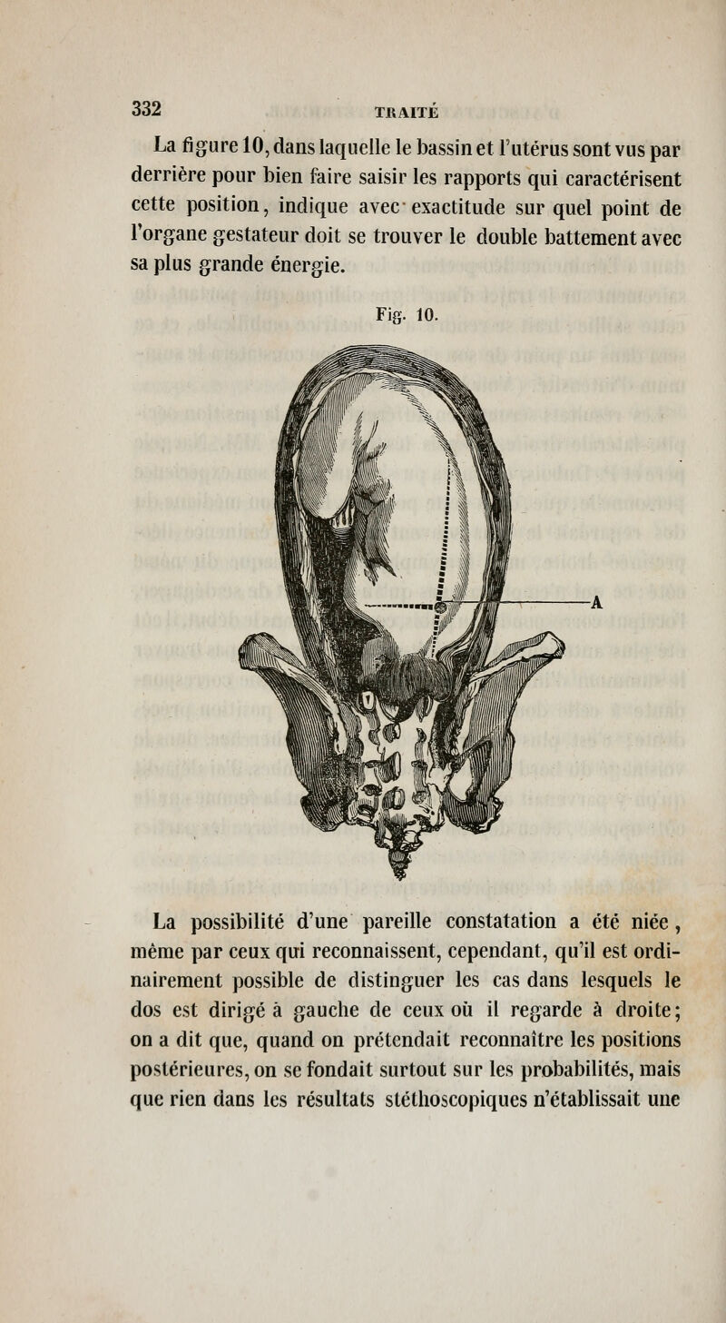 La figure 10, dans laquelle le bassin et l'utérus sont vus par derrière pour bien faire saisir les rapports qui caractérisent cette position, indique avec exactitude sur quel point de Torgane gestateur doit se trouver le double battement avec sa plus grande énergie. Fig. 10. La possibilité d'une pareille constatation a été niée, même par ceux qui reconnaissent, cependant, qu'il est ordi- nairement possible de distinguer les cas dans lesquels le dos est dirigea gauche de ceux où il regarde à droite; on a dit que, quand on prétendait reconnaître les positions postérieures, on se fondait surtout sur les probabilités, mais que rien dans les résultats sléthoscopiques n'établissait une