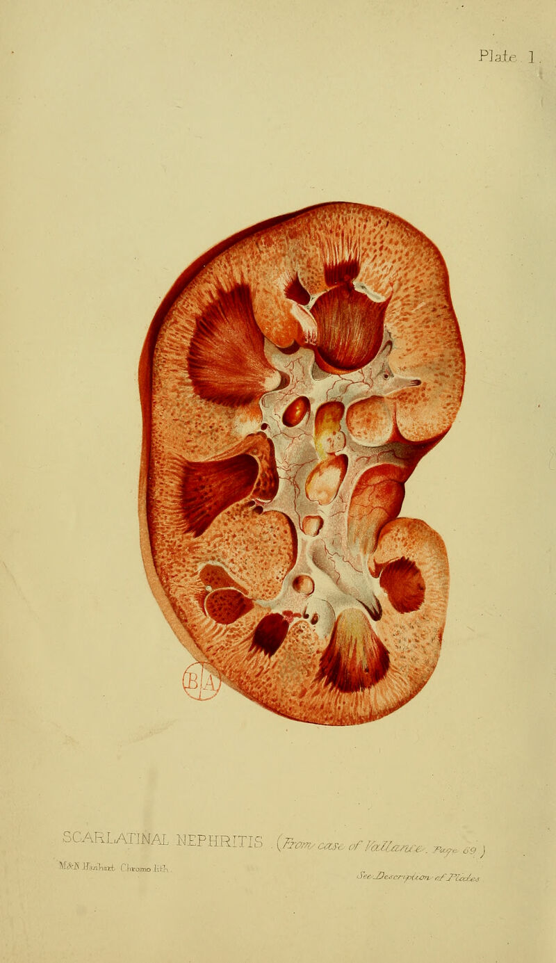 Plaie 1 SCARLATJMAL NEPHRITIS {Fro. « , .,. , , ; ' ■ '•..-! CJwOBoJifl, Vee/2)ascription . ■' /]'.'■ A ,