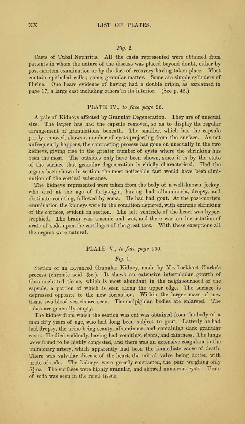 Fig. 2. Casts of Tubal Nephritis. All the casts represented were obtained from patients in whom the nature of the disease was placed beyond doubt, either by post-mortem examination or by the fact of recovery having taken place. Most contain epithelial cells ; some, granular matter. Some are simple cylinders of fibrine. One bears evidence of having had a double origin, as explained in page 17, a large cast including others in its interior. (See p. 42.) PLATE IV., to face page 96. A pair of Kidneys affected by Granular Degeneration. They are of unequal size. The larger has had the capsule removed, so as to display the regular arrangement of granulations beneath. The smaller, which has the capsule partly removed, shows a number of cysts projecting from the surface. As not unfrequently happens, the contracting process has gone on unequally in the two kidneys, giving rise to the greater number of cysts where the shrinking has been the most. The outsides only have been shown, since it is by the state of the surface that granular degeneration is chiefly characterised. Had the organs been shown in section, the most noticeable fact would have been dimi- nution of the cortical substance. The kidneys represented were taken from the body of a well-known jockey, who died at the age of forty-eight, having had albuminuria, dropsy, and obstinate vomiting, followed by coma. He had had gout. At the post-mortem examination the kidneys were in the condition depicted, with extreme shrinking of the cortices, evident on section. The left ventricle of the heart was hyper- trophied. The brain was ansemic and wet, and there was an incrustation of urate of soda upon the cartilages of the great toes. With these exceptions all the organs were natural. PLATE V., to face page 100. Fig. 1. Section of an advanced Granular Kidney, made by Mr. Lockhart Clarke's process (chrom:c acid, &c). It shows an extensive intertubular growth of fibro-nucleated tissue, which is most abundant in the neighbourhood of the capsule, a portion of which is seen along the upper edge. The surface is depressed opposite to the new formation. Within the larger mass of new tissue two blood vessels are seen. The malpighian bodies are enlarged. The tubes are generally empty. The kidney from which the section was cut was obtained from the body of a man fifty years of age, who had long been subject to gout. Latterly he had had dropsy, the urine being scanty, albuminous, and containing dark granular casts. He died suddenly, having had vomiting, rigors, and faintness. The lungs were found to be highly congested, and there was an extensive coagulum in the pulmonary artery, which apparently had been the immediate cause of death. There was valvular disease of the heart, the mitral valve being dotted with urate of soda. The kidneys were greatly contracted, the pair weighing only oh oz. The surfaces were highly granular, and showed numerous cysts. Urate of soda was seen in the renal tissue.