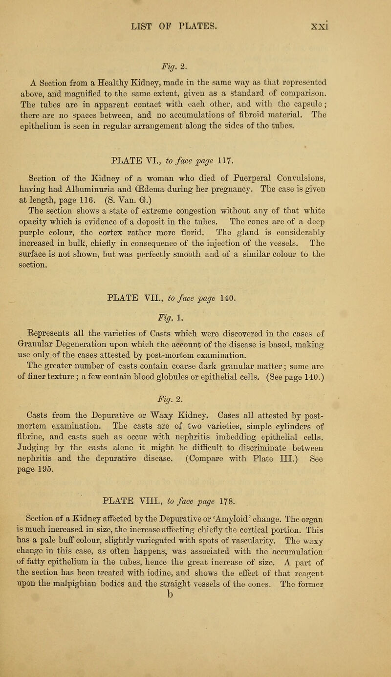 Fig. 2. A Section from a Healthy Kidney, made in the same way as that represented above, and magnified to the same oxtont, given as a standard of comparison. The tubes are in apparent contact with each other, and with tho capsulo; there are no spaces between, and no accumulations of fibroid material. Tho epithelium is seen in regular arrangement along the sides of the tubes. PLATE VI., to face page 117. Section of the Kidney of a woman who died of Puerperal Convulsions, having had Albuminuria and (Edema during her pregnancy. The case is given at length, page 116. (S. Van. Gr.) The section shows a state of extreme congestion without any of that white opacity which is evidence of a deposit in the tubes. The cones are of a deep purple colour, the cortex rather more florid. The gland is considerably increased in bulk, chiefly in consequence of the injection of the vessels. The surface is not shown, but was perfectly smooth and of a similar colour to the section. PLATE VII., to face page 140. Fig. 1. Eepresents all the varieties of Casts which were discovered in the cases of Granular Degeneration upon which the account of the disease is based, making use only, of the cases attested by post-mortem examination. The greater number of casts contain coarse dark granular matter; some are of finer texture; a few contain blood globules or epithelial cells. (See page 140.) Fig. 2. Casts from the Depurative or Waxy Kidney. Cases all attested by post- mortem examination. The casts are of two varieties, simple cylinders of fibrine, and casts such as occur with nephritis imbedding epithelial cells. Judging by the casts alone it might be difficidt to discriminate between nephritis and the depurative disease. (Compare with Plate III.) See page 195. PLATE VIII., to face page 178. Section of a Kidney affected by the Depurative or 'Amyloid' change. The organ is much increased in size, the increase affecting chiefly the cortical portion. This has a pale buff colour, slightly variegated with spots of vascularity. The waxy change in this case, as often happens, was associated with the accumulation of fatty epithelium in the tubes, hence the great increase of size. A part of the section has been treated with iodine, and shows the effect of that reagent upon the malpighian bodies and the straight vessels of the cones. The former b