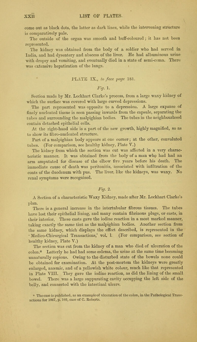 come out as black dots, the latter as dark lines, while the intervening structure is comparatively pale. The outside of the organ was smooth and buff-coloured ; it has not been represented. The kidney was obtained from the body of a soldier who had served in India, and had dysentery and abscess of the liver. He had albuminous urine with dropsy and vomiting, and eventually died in a state of semi-coma. There was extensive hepatization of the lungs. PLATE IX., to face page 181. Fig. 1. Section made by Mr. Lockhart Clarke's process, from a large waxy kidney of which the surface was covered with large curved depressions. The part represented was opposite to a depression. A large expanse of finely nucleated tissue is seen passing inwards from the capsule, separating the tubes and surrounding the malpighian bodies. The tubes in the neighbourhood contain detached epithelial cells. At the right-hand side is a part of the new growth, highly magnified, so as to show its fibro-nucleated structure. Part of a malpighian body appears at one corner; at the other, convoluted tubes. (For comparison, see healthy kidney, Plate V.) The kidney from which the section was cut was affected in a very charac- teristic manner. It was obtained from the body of a man who had had an arm amputated for disease of ihe elbow five, years before his death. The immediate cause of death was peritonitis, associated with infiltration of the coats of the duodenum with pus. The liver, like the kidneys, was waxy. No renal symptoms were recognised. Fig. 2. A Section of a characteristic Waxy Kidney, made after Mr. Lockhart Clarke's plan. There is a general increase in the intertubular fibrous tissues. The tubes have lost their epithelial lining, and many contain fibrinous plugs, or casts, in their interior, These casts gave the iodine reaction in a most marked manner, taking exactly the same tint as the malpighian bodies. Another section from the same kidney, which displays the effect described, is represented in the ' Medico-Chirurgical Transactions,' vol. 1. (For comparison, see section of healthy kidney, Plate V.) The section was cut from the kidney of a man who died of ulceration of the colon.* Latterly he had had some cedema, the urine at the same time becoming unnaturally copious. Owing to the disturbed state of the bowels none could be obtained for examination. At the post-mortem the kidneys were greatly enlarged, angemic, and of a yellowish white colour, much like that represented in Plate VIII. They gave the iodine reaction, as did the lining of the small bowel. There was a large suppurating cavity occupying the left side of the belly, and connected with the intestinal ulcers. * The case is published, as an example of ulceration of the colon, in the Pathological Trans- actions for 1867, p. 102, case of C. Roberts.