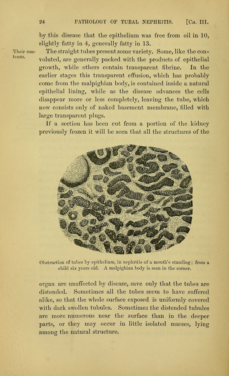 Their con- tents. by this disease that the epithelium was free from oil in 10, slight!}? fatty in 4, generally fatty in 13. The straight tubes present some variety. Some, like the con- voluted, are generally packed with the products of epithelial growth, while others contain transparent fibrine. In the earlier stages this transparent effusion, which has probably come from the malpighian body, is contained inside a natural epithelial lining, while as the disease advances the cells disappear more or less completely, leaving the tube, which now consists only of naked basement membrane, filled with large transparent plugs. If a section has been cut from a portion of the kidney previously frozen it will be seen that all the structures of the Obstruction of tubes by epithelium, in nephritis of a month's standing; from a child six years old. A malpighian body is seen in the corner. organ are unaffected by disease, save only that the tubes are distended. Sometimes all the tubes seem to have suffered alike, so that the whole surface exposed is uniformly covered with dark swollen tubules. Sometimes the distended tubules are more numerous near the surface than in the deeper parts, or they may occur in little isolated masses, lying among the natural structure.