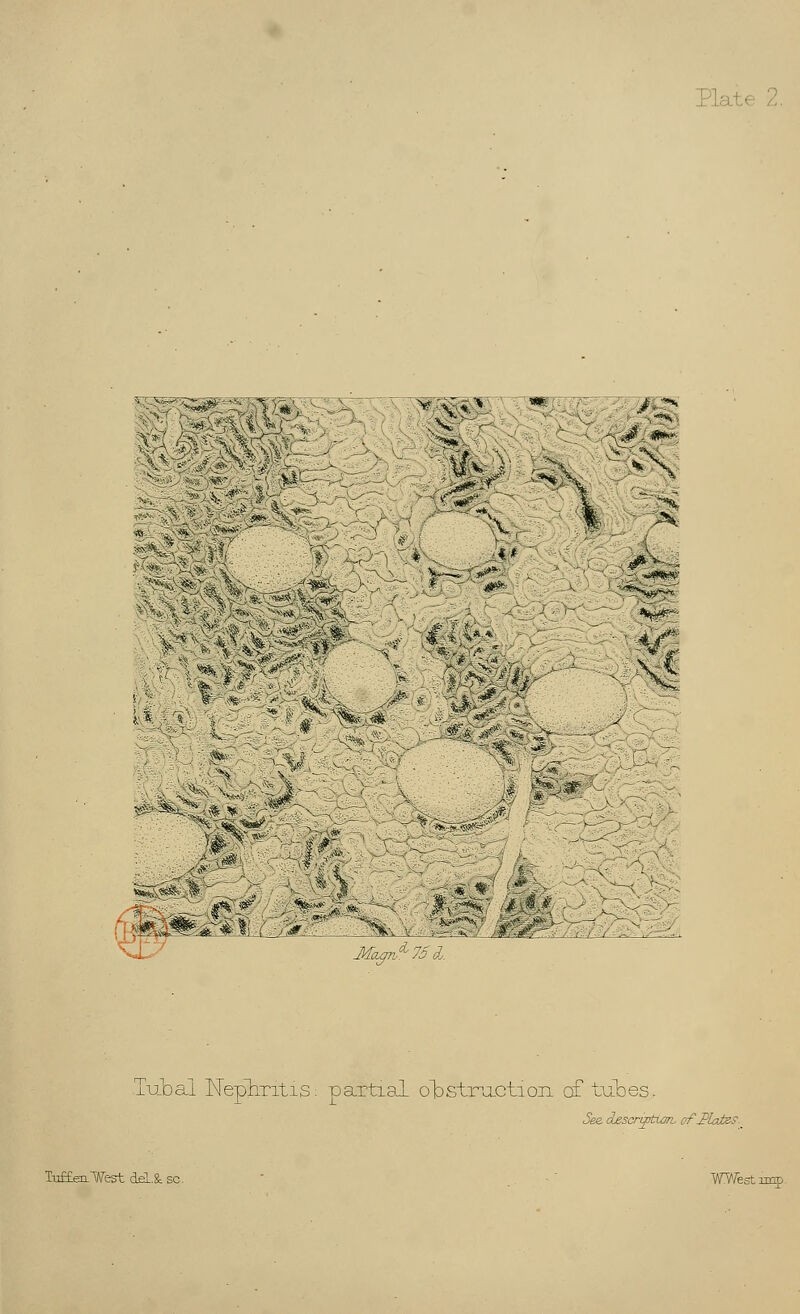W *fc  'Ail fed - ' i *mg&? v \™>> V.'f.vvv ,r. .*■-.■■». J-*5*^. NX7 M^75l. Tubal Nephritis: partial obstruction of tubes. See. description- of-PlatzP Tu££enWest deL&sc. ' . VWestimp.