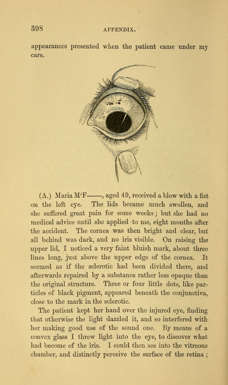 appearances presented when the patient came under my care. (A.) Maria M'F , aged 49, received a blow with a fist on the left eye. The lids became much swollen, and she suffered great pain for some weeks; but she had no medical advice until she applied to me, eight months after the accident. The cornea was then bright and clear, but all behind was dark, and no iris visible. On raising the upper lid, I noticed a very faint bluish mark, about three lines long, just above the upper edge of the cornea. It seemed as if the sclerotic had been divided there, and afterwards repaired by a substance rather less opaque than the original structure. Three or four little dots, like par- ticles of black pigment, appeared beneath the conjunctiva, close to the mark in the sclerotic. The patient kept her hand over the injured eye, finding that otherwise the light dazzled it, and so interfered with her making good use of the sound one. By means of a convex glass I threw light into the eye, to discover what had become of the iris. I could then see into the vitreous chamber, and distinctly perceive the surface of the retina ;