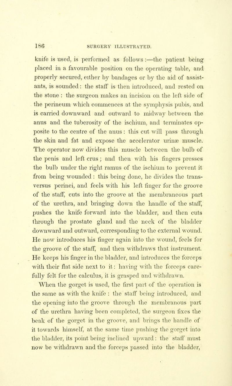 knife is tised, is performed as follows :—the patient being placed in a favourable position on the operating table, and properly secured, either by bandages or by the aid of assist- ants, is sounded: the staff is then introduced, and rested on the stone : the surgeon makes an incision on the left side of the perineum which commences at the symphysis pubis, and is carried downward and outward to midway between the anus and the tuberosity of the ischium, and terminates op- posite to the centre of the anus : this cut will pass through the skin and fat and expose the accelerator minae muscle. The operator now divides this muscle between the bulb of the penis and left crus; and then with his fingers presses the bulb under the right ramus of the ischium to prevent it from being wounded : this being done, he divides the trans- versus perinei, and feels with his left finger for the groove of the staff, cuts into the groove at the membraneous part of the urethra, and bringing down the handle of the staff, pushes the knife forward into the bladder, and then cuts through the prostate gland and the neck of the bladder dowTiward and outward, corresponding to the external wound. He now introduces his finger again into the wound, feels for the groove of the staff, and then withdi'aws that instrument. He keeps his finger in the bladder, and introduces the forceps with their flat side next to it: having with the forceps care- fully felt for the calculus, it is grasped and withdrawn. When the gorget is used, the first part of the operation is the same as with the knife : the staff being introduced, and the opening into the groove through the membranous part of the urethra having been completed, the surgeon fixes the beak of the gorget in the groove, and brings the handle of it towards himself, at the same time pushing the gorget into the bladder, its point being inclined upward: the staff must now be withdrawn and the forceps passed into the bladder,