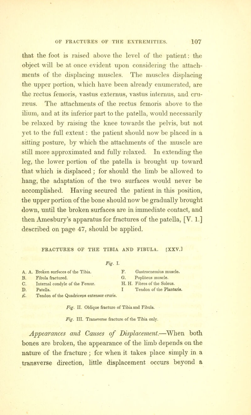 that the foot is raised above the level of the patient: the object will be at once evident upon considering the attach- ments of the displacing muscles. The muscles displacing the upper portion, which have been already enumerated, are the rectus femoris, vastus externus, vastus internus, and cru- rseus. The attachments of the rectus femoris above to the ilium, and at its inferior part to the patella, would necessarily be relaxed by raising the knee towards the pelvis, but not yet to the full extent: the patient should now be placed in a sitting posture, by which the attachments of the muscle are still more approximated and fully relaxed. In extending the leg, the lower portion of the patella is brought up toward that which is displaced; for should the limb be allowed to hang, the adaptation of the two surfaces would never be accomplished. Having secured the patient in this position, the upper portion of the bone should now be gradually brought down, until the broken surfaces are in immediate contact, and then Amesbury's apparatus for fractures of the patella, [V. 1.] described on page 47, should be applied. FRACTURES OF THE TIBIA AND FIBULA. [XXV.] Fig. I. A. A. Broken surfaces of the Tibia. F. Gastrocnemius muscle. B. Fibula fractured. G. Popliteus muscle. C. Internal condyle of the Femur. H. H. Fibres of the Soleus. D. Patella. I Tendon of the Plantaiis. jS. Tendon of the Quadriceps extensor cruris. Fig. II. Oblique fracture of Tibia and Fibula. Fig. III. Transverse fracture of the Tibia only. Appearances and Causes of Displacement.—When both bones are broken, the appearance of the limb depends on the nature of the fracture ; for when it takes place simply in a transverse direction, little displacement occurs beyond a