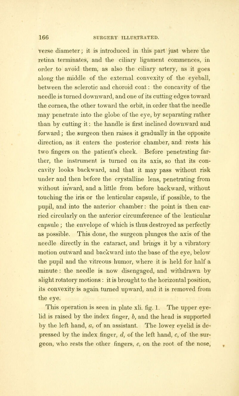 verse diameter; it is introduced in this part just where the retina terminates, and the ciliary ligament commences, in order to avoid them, as also the ciliary artery, as it goes along the middle of the external convexity of the eyeball, between the sclerotic and choroid coat: the concavity of the needle is turned downward, and one of its cutting edges toward the cornea, the other toward the orbit, in order that the needle may penetrate into the globe of the eye, by separating rather than by cutting it: the handle is first inclined downward and forward; the surgeon then raises it gradually in the opposite direction, as it enters the posterior chamber, and rests his two fingers on the patient's cheek. Before penetrating far- ther, the instrument is turned on its axis, so that its con- cavity looks backward, and that it may pass without risk under and then before the crystalline lens, penetrating from without inward, and a little from before backward, without touching the iris or the lenticular capsule, if possible, to the pupil, and into the anterior chamber: the point is then car- ried circularly on the anterior circumference of the lenticular capsule ; the envelope of which is thus destroyed as perfectly as possible. This done, the surgeon plunges the axis of the needle directly in the cataract, and brings it by a vibratory motion outward and backward into the base of the eye, below the pupil and the vitreous humor, where it is held for half a minute : the needle is now disengaged, and withdrawn by slight rotatory motions : it is brought to the horizontal position, its convexity is again turned upward, and it is removed from the eye. This operation is seen in plate xli. fig. 1. The upper eye- lid is raised by the index finger, b, and the head is supported by the left hand, a, of an assistant. The lower eyelid is de- pressed by the index finger, d, of the left hand, c, of the sur- geon, who rests the other fingers, e, on the root of the nose,