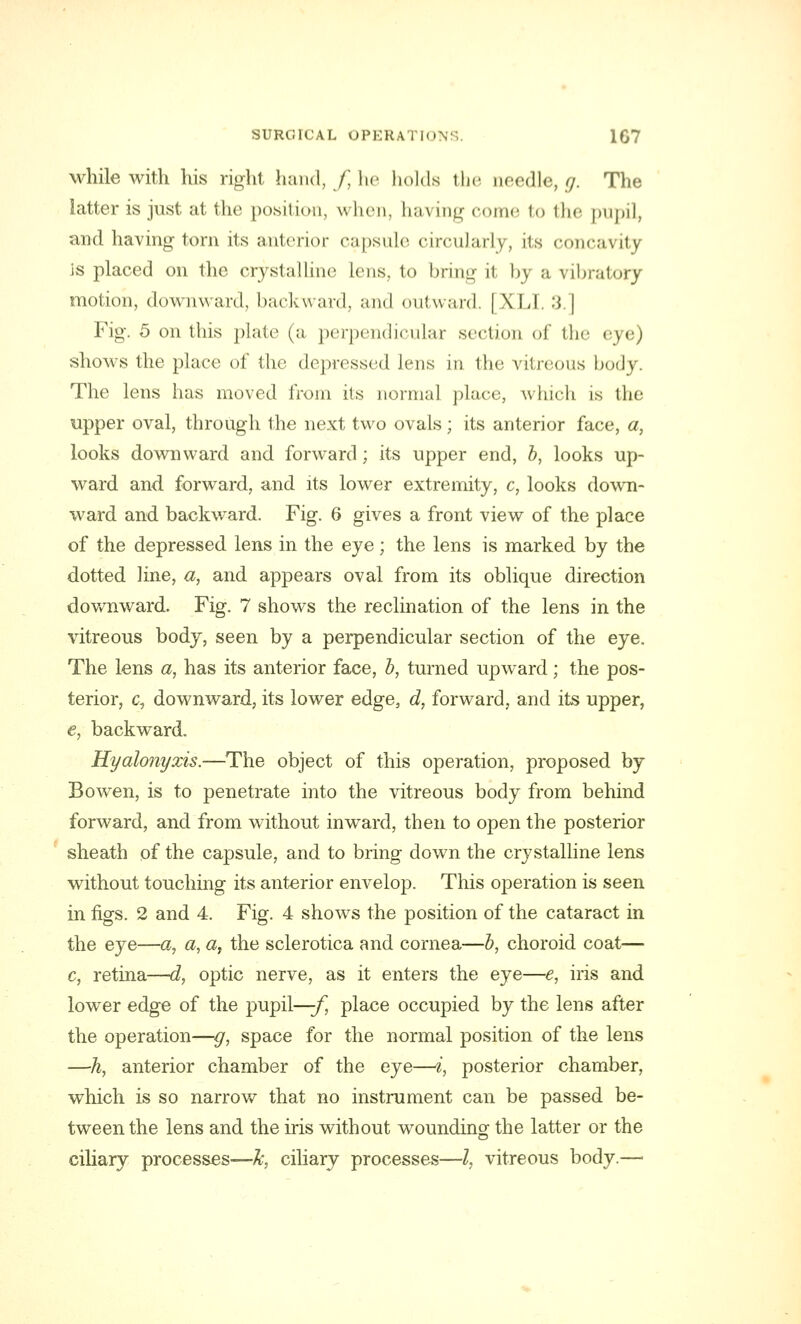 while with his right hand, /, he holds the needle, g. The latter is just at the position, when, having come to the pupil, and having torn its anterior capsule circularly, its concavity is placed on the crystalline lens, to bring it by a vibratory motion, downward, backward, and outward. | XL! 3.] Fig. 5 on this plate (a perpendicular section of the eye) shows the place of the depressed lens in the vitreous body. The lens has moved from its normal place, which is the upper oval, through the next two ovals; its anterior face, «, looks downward and forward; its upper end, b, looks up- ward and forwrard, and its lower extremity, c, looks down- ward and backward. Fig. 6 gives a front view of the place of the depressed lens in the eye; the lens is marked by the dotted line, a, and appears oval from its oblique direction downward. Fig. 7 shows the reclination of the lens in the vitreous body, seen by a perpendicular section of the eye. The lens a, has its anterior face, b, turned upward; the pos- terior, c, downward, its lower edge, d, forward, and its upper, e, backward. Hyalonyxis.—The object of this operation, proposed by Bowen, is to penetrate into the vitreous body from behind forward, and from without inward, then to open the posterior sheath of the capsule, and to bring down the crystalline lens without touching its anterior envelop. This operation is seen in figs. 2 and 4. Fig. 4 shows the position of the cataract in the eye—#, a, a, the sclerotica and cornea—b, choroid coat— c, retina—d, optic nerve, as it enters the eye—e, iris and lower edge of the pupil—-f, place occupied by the lens after the operation—g, space for the normal position of the lens ■—h, anterior chamber of the eye—i, posterior chamber, which is so narrow that no instrument can be passed be- tween the lens and the iris without wounding the latter or the ciliary processes—Ic, ciliary processes—I, vitreous body.—