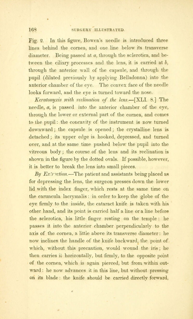 Fig. 2. In this figure, Bowen's needle is introduced three lines behind the cornea, and one line below its transverse diameter. Being passed at a. through the sclerotica, and be- tween the ciliary processes and the lens, it is carried at b, through the anterior wall of the capsule, and through the pupil (dilated previously by applying Belladonna) into the anterior chamber of the eye. The convex face of the needle looks forward, and the eye is turned toward the nose. Keratonyxis with redination of the lens.—[XLI. 8.] The needle, a, is passed into the anterior chamber of the eye, through the lower or external part of the cornea, and comes to the pupil: the concavity of the instrument is now turned downward; the capsule is opened; the crystalline lens is detached; its upper edge is hooked, depressed, and turned over, and at the same time pushed below the pupil into the vitreous body; the course of the lens and its reclination is shown in the figure by the dotted ovals. If possible, however, it is better to break the lens into small pieces. By Extraction.—The patient and assistants being placed as for depressing the lens, the surgeon presses down the lower lid with the index finger, which rests at the same time on the caruncula lacrymalis: in order to keep the globe of the eye firmly to the inside, the cataract knife is taken with his other hand, and its point is carried half a line or a line before the sclerotica, his little finger resting on the temple : he passes it into the anterior chamber perpendicularly to the axis of the cornea, a little above its transverse diameter: he now inclines the handle of the knife backward, the point of which, without this precaution, would wound the iris; he then carries ic horizontally, but firmly, to the opposite point of the cornea, which is again pierced, but from within out- ward : he now advances it in this line, but without pressing on its blade : the knife should be carried directly forward.