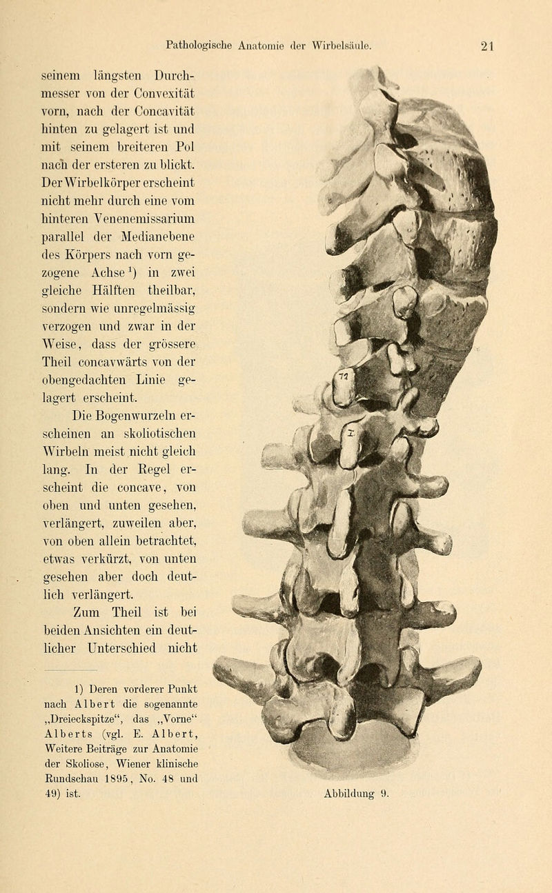 seinem längsten Durch- messer von der Convexität vorn, nach der Concavität hinten zu gelagert ist und mit seinem breiteren Pol nach der ersteren zu blickt. Der Wirbelkörper erscheint nicht mehr durch eine vom hinteren Venenemissarium parallel der Medianebene des Körpers nach vorn ge- zogene Achse1) in zwei gleiche Hälften theilbar, sondern wie unregelmässig verzogen und zwar in der Weise, dass der grössere Theil concavwärts von der obengedachten Linie ge- lagert erscheint. Die Bogenwurzeln er- scheinen an skoliotischen Wirbeln meist nicht gleich lang. In der Regel er- scheint die concave, von oben und unten gesehen, verlängert, zuweilen aber, von oben allein betrachtet, etwas verkürzt, von unten gesehen aber doch deut- lich verlängert. Zum Theil ist bei beiden Ansichten ein deut- licher Unterschied nicht 1) Deren vorderer Punkt nach Albert die sogenannte „Dreieckspitze, das „Vorne Alberts (vgl. E. Albert, Weitere Beiträge zur Anatomie der Skoliose, Wiener klinische Eundschau 1895, No. 48 und
