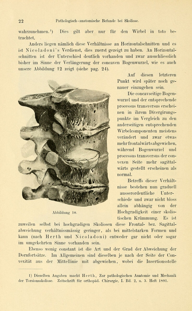 wahrzunehmen.1) Dies gilt aber nur für den Wirbel in toto be- trachtet. . Anders liegen nämlich diese Verhältnisse an Horizontalschnitten und es ist Nicoladoni's Verdienst, dies zuerst gezeigt zu haben. An Horizontal- schnitten ist der Unterschied deutlich vorhanden und zwar ausschliesslich bisher im Sinne der Verlängerung der concaven Bogenwurzel, wie es auch unsere Abbildung 12 zeigt (siehe pag. 24). Auf diesen letzteren Punkt wird später noch ge- nauer einzugehen sein. Die concavseitige Bogen- wurzel und der entsprechende Processus transversus erschei- nen in ihrem Divergirungs- punkte im Vergleich zu den anderseitigen entsprechenden Wirbelcomponenten meistens verändert und zwar etwas mehr frontalwärts abgewichen, während Bogenwurzel und Processus transversus der con- vexen Seite mehr sagittal- wärts gestellt erscheinen als normal. Betreffs dieser Verhält- nisse bestehen nun graduell ausserordentliche Unter- schiede und zwar nicht bloss allein abhängig von der Hochgradigkeit einer skolio- tischen Krümmung. Es ist zuweilen selbst bei hochgradigen Skoliosen diese Frontal- bez. Sagittal- abweichung verhältnissmässig geringer, als bei mittelstarken Formen und kann (nach Herth und Nicoladoni) entweder gar nicht oder sogar im umgekehrten Sinne vorhanden sein. Ebenso wenig constant ist die Art und der Grad der Abweichung der Dornfortsätze. Im Allgemeinen sind dieselben je nach der Seite der Con- vexität aus der Mittellinie mit abgewichen, wobei die Insertionsstelle Abbildung 10. 1) Dieselben Angaben macht Herth, Zur pathologischen Anatomie und Mechanik der Torsionsskoliose. Zeitschrift für Orthopäd. Chirurgie, I. Bd. 2. u. 3. Heft 1891.