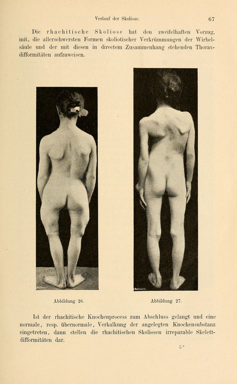 Die rhac hitische Skoliose hat den zweifelhaften Vorzug, mit, die allerschwersten Formen skoliotischer Verkrümmungen der Wirbel- säule und der mit diesen in directem Zusammenhang stehenden Thorax- difformitäten aufzuweisen. Abbildung 26. Abbildung 27. Ist der rhachitische Knochenprocess zum Abschluss gelangt und eine normale, resp. übernormale, Verkalkung der angelegten Knochensubstanz eingetreten, dann stellen die rhachitischen Skoliosen irreparable Skelett- difformitäten dar.