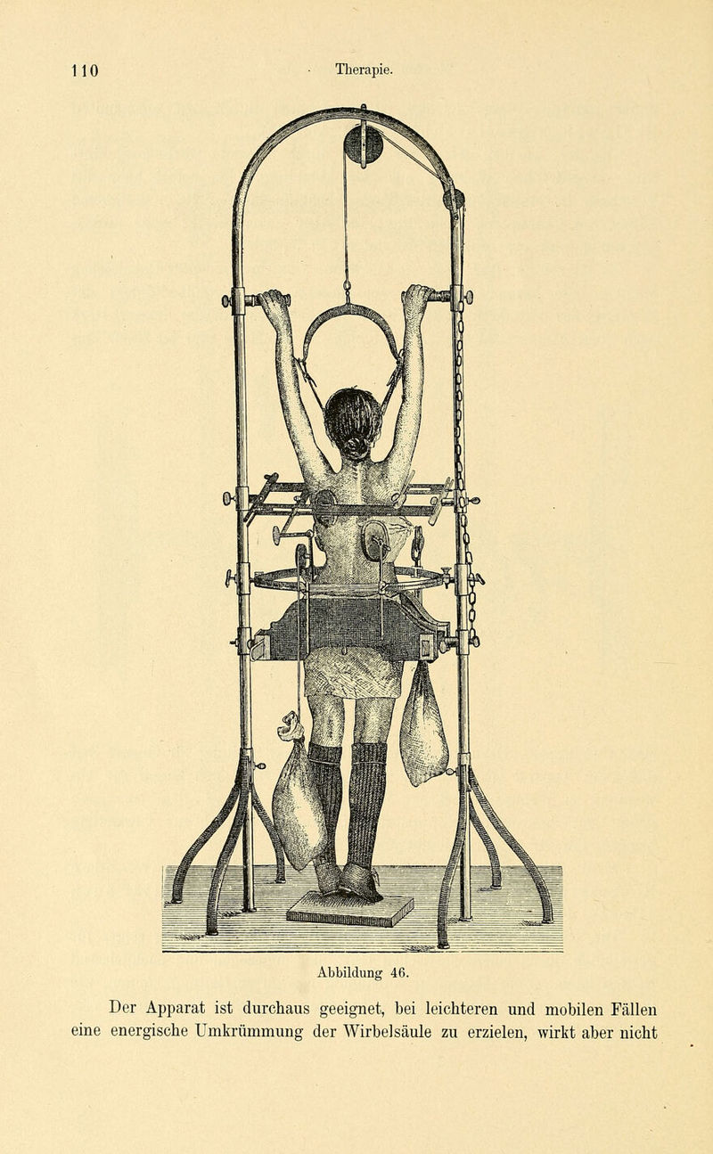 Abbildung 46. Der Apparat ist durchaus geeignet, bei leichteren und mobilen Fällen eine energische Umkrümmung der Wirbelsäule zu erzielen, wirkt aber nicht