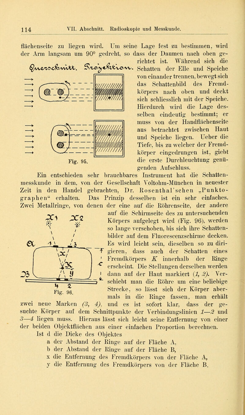 Fig. 95. flächenseite zu liegen wird. Um seine Lage fest zu bestimmen, wird der Arm langsam um 90° gedreht, so dass der Daumen nach oben ge- , _ richtet ist. Während sich die §wc/t/?<^/vvU^. 5A.o^*^^^vo/w. Schatten der Elle und Speiche von einander trennen, bewegt sich das Schattenbild des Fremd- körpers nach oben und deckt sich schliesslich mit der Speiche. Hierdurch wird die Lage des- selben eindeutig bestimmt; er muss von der Handflächenseite aus betrachtet zwischen Haut und Speiche liegen, lieber die Tiefe, bis zu welcher der Fremd- körper eingedrungen ist, giebt die erste Durchleuchtung genü- genden Aufschluss. Ein entschieden sehr brauchbares Instrument hat die Schatten- messkunde in dem, von der Gesellschaft Yoltohm-München in neuester Zeit in den Handel gebrachten, Dr. ßosenthal'sehen „Punkto- graphen erhalten. Das Prinzip desselben ist ein sehr einfaches. Zwei Metallringe, von denen der eine auf die Eöhrenseite, der andere auf die Schirmseite des zu untersuchenden Körpers aufgelegt wird (Fig. 96), werden so lange verschoben, bis sich ihre Schatten- bilder auf dem Fluorescenzschirme decken. Es wird leicht sein, dieselben so zu diri- T gieren, dass auch der Schatten eines ' Fremdkörpers K innerhalb der Ringe erscheint. Die Stellungen derselben werden I dann auf der Haut markiert (1, 2). Ver- schiebt man die Röhre um eine beliebige Strecke, so lässt sich der Körper aber- mals in die Ringe fassen, man erhält zwei neue Marken (3, d), und es ist sofort klar, dass der ge- suchte Körper auf dem Schnittpunkte der Verbindungslinien 1—2 und 3—d liegen muss. Hieraus lässt sich leicht seine Entfernung von einer der beiden Objektflächen aus einer einfachen Proportion berechnen. Ist d die Dicke des Objektes a der Abstand der Ringe auf der Fläche A, b der Abstand der Ringe auf der Fläche B, X die Entfernung des Fremdkörpers von der Fläche A, j die Entfernung des Fremdkörpers von der Fläche B,