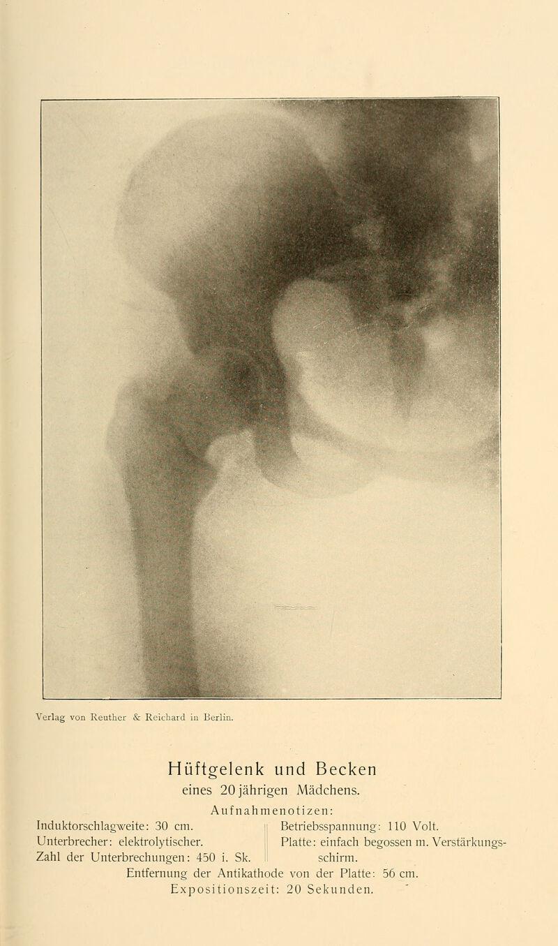 Verlag von Reuther & Reichaid iu Berlin. Hüftgelenk und Becken eines 20 jährigen Mädchens. Aufnahmenotizen: Induktorschlagweite: 30 cm. Unterbrecher: elektrolytischer. Zahl der Unterbrechungen: 450 i. Sk. Betriebsspannung: 110 Volt. Platte: einfach begossen m. Verstärkungs- schirm. Entfernung der Antikathode von der Platte: 56 cm. Expositionszeit: 20 Sekunden.