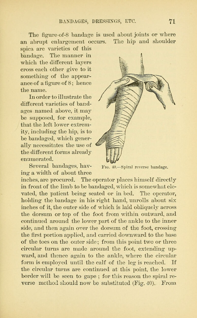 The figure-of-8 bandage is used about joints or where an abrupt enlargenjent occurs. Tlie hip and shoulder spica are varieties of this bandage. The manner in which the different layers cross each other give to it something of the appear- ance of a figure of 8; hence the name. In order to illustrate the different varieties of band- ages named above, it may be supposed, for example, that the left lower extrem- ity, including the hip, is to be bandaged, which gener- ally necessitates the use of the different forms already enumerated. Several bandages, hav- ing a width of about three inches, are procured. The operator places himself directly in front of the limb to be bandaged, which is somewhat ele- vated, the patient being seated or in bed. The operator, holding the bandage in his right hand, unrolls about six inches of it, the outer side of which is laid obliquely across the dorsum or top of the foot from within outward, and continued around the lower part of the ankle to the inner side, and then again over the dorsum of the foot, crossing the fii'st portion applied, and carried downward to the base of the toes on the outer side; from this point two or three circular turns are made around the foot, extending up- ward, and thence again to the ankle, where the circular form is emiDloyed until the calf of the leg is reached. If the circular turns are continued at this pouit, the lower border will be seen to gape ; for this reason the spiral re- Fig. 40.—Spiral reverse bandage.