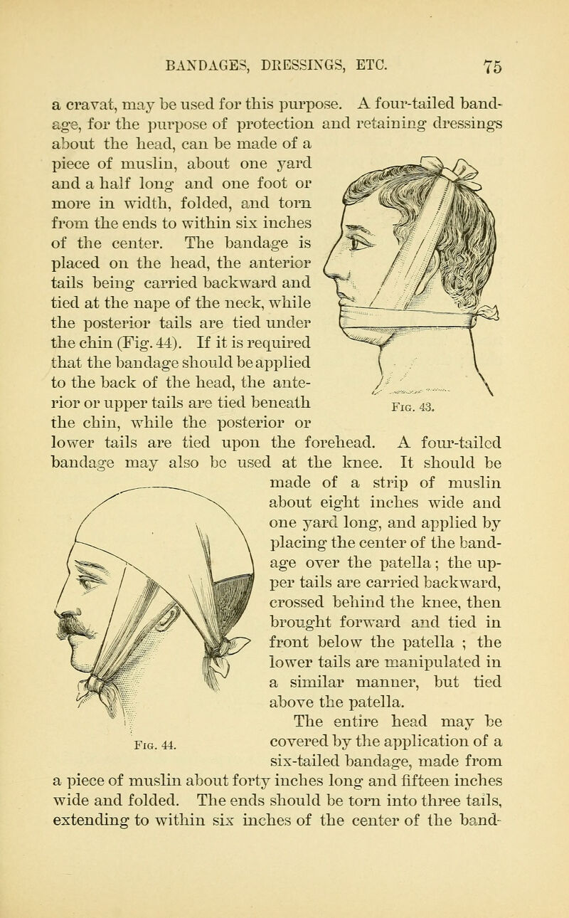 a cravat, may be used for this purpose. A four-tailed band- age, for the purpose of protection and retaining dressings about the head, can be made of a piece of muslin, about one yard and a half long and one foot or more in width, folded, and torn from the ends to within six inches of the center. The bandage is placed on the head, the anterior tails being carried backward and tied at the nape of the neck, while the posterior tails are tied under the chin (Fig. 44). If it is required that the bandage should be applied to the back of the head, the ante- rior or upper tails are tied beneath the chin, while the posterior or lower tails are tied upon the forehead, bandage may also be used at the knee. made of a Fig. 43. A four-tailed It should be strip of muslin about eight inches wide and one yard long, and applied by placing the center of the band- age over the patella ; the up- per tails are carried backward, crossed behind the knee, then brought forward and tied in front below the patella ; the lower tails are manipulated in a similar manner, but tied above the patella. The entire head may be covered by the application of a six-tailed bandage, made from a piece of muslin about forty inches long and fifteen inches wide and folded. The ends should be torn into three tails, extending to within six inches of the center of the band-