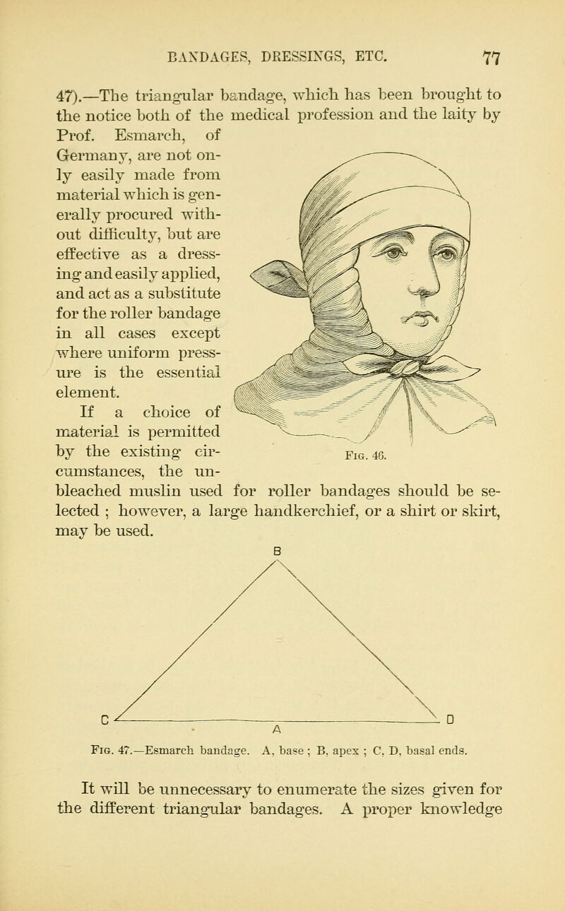 47).—The triangular bandage, which has been brought to the notice both of the medical profession and the laity by Prof. Esmarch, of Germany, are not on- ly easily made from material which is gen- erally procured with- out difficulty, but are effective as a dress- ing and easily applied, and act as a substitute for the roller bandage in all cases except where uniform press- ure is the essential element. If a choice of material is permitted by the existing cir- cumstances, the un- bleached muslin used for roller bandages should be se- lected ; however, a large handkerchief, or a shirt or skirt, may be used. Fig. 48. Fig. 47.—Esmarch bandage. A, base ; B, apex ; C, D, basal ends. It will be unnecessary to enumerate the sizes given for the different triangular bandages. A proper knowledge