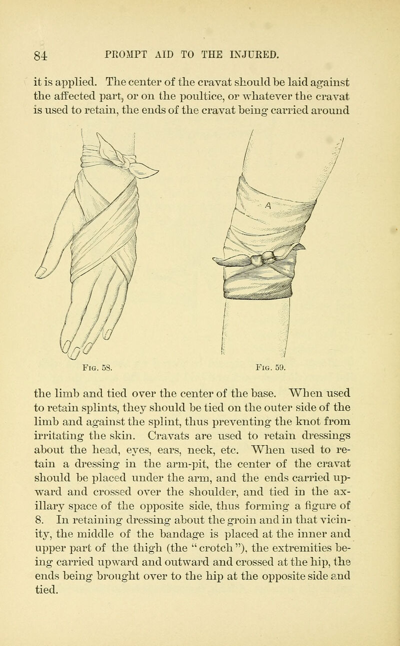 it is applied. The center of the cravat should be laid against the affected partj or on the poultice, or whatever the cravat is used to retain, the ends of the cravat beino: carried around Fig. 58. Fig. 59. the limb and tied over the center of the base. When used to retain splints, they should be tied on the outer side of the limb and against the splint, thus preventing the knot from irritating the skin. Cravats are used to retain dressings about the head, eyes, ears, neck, etc. When used to re- tain a dressing in the arm-pit, the center of the cravat should be placed under the arm, and the ends carried up- ward and crossed over the shoulder, and tied in the ax- illary space of the opposite side, thus forming a figure of 8. In retaining dressing about the groin and in that vicin- ity, the middle of the bandage is placed at the inner and upper part of the thigh (the  crotch ), the extremities be- ing carried upward and outward and crossed at the hip, the ends being brought over to the hip at the opposite side and tied.