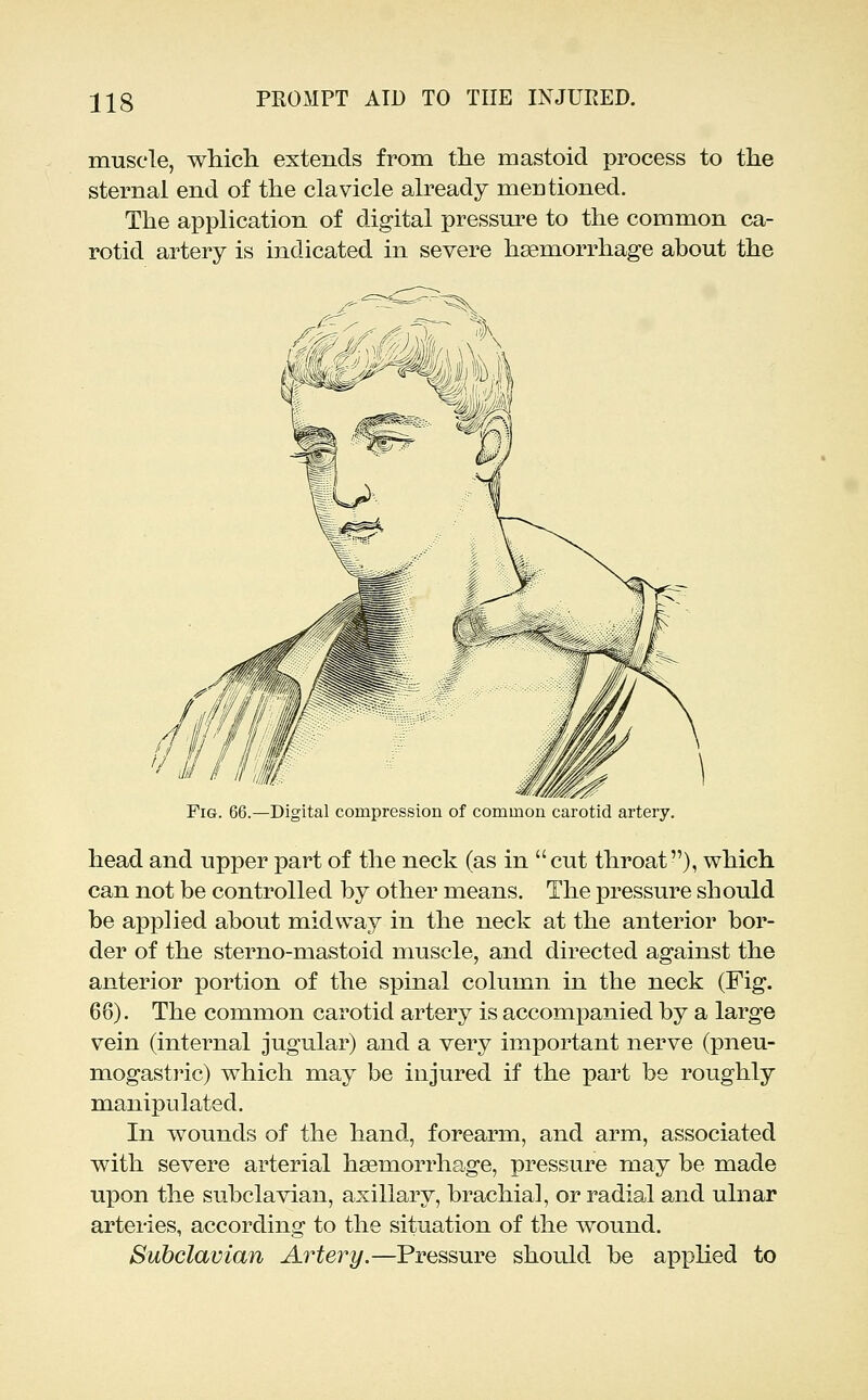 muscle, whicli extends from the mastoid process to the sternal end of the clavicle already mentioned. The application of digital pressm'e to the common ca- rotid artery is indicated in severe haemorrhage about the Fig. 66.—Digital compression of common carotid artery, head and upper part of the neck (as in cut throat), which can not be controlled by other means. The pressure should be applied about midway in the neck at the anterior bor- der of the sterno-mastoid muscle, and directed against the anterior portion of the spinal column in the neck (Fig. 66). The common carotid artery is accompanied by a large vein (internal jugular) and a very important nerve (pneu- mogastric) which may be injured if the part be roughly manipulated. In wounds of the hand, forearm, and arm, associated with severe arterial haemorrhage, pressure may be made upon the subclavian, axillary, brachial, or radial and ulnar arteries, according to the situation of the wound. Subclavian Artery.—Pressure should be applied to