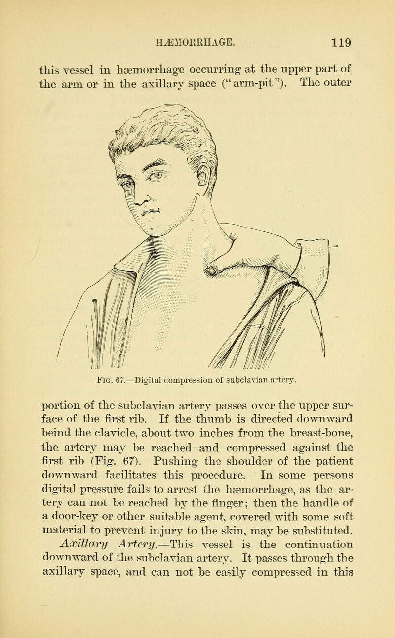 this vessel in haemorrhage occurring at the upper part of the arm or in the axillary space (arm-pit). The outer Fig. 67.—Digital compression of subclavian artery. portion of the subclavian artery passes over the upper sur- face of the first rib. If the thumb is directed downward beind the clavicle, about two inches from the breast-bone, the artery may be reached and compressed against the first rib (Fig. 67). Pushing the shoulder of the patient downward facilitates this procedure. In some persons digital pressure fails to arrest the haemorrhage, as the ar- tery can not be reached by the finger; then the handle of a door-key or other suitable agent, covered with some soft material to prevent injury to the skin, may be substituted. Axillary Artery.—This vessel is the continuation downward of the subclavian artery. It passes through the axillary space, and can not be easily compressed in this