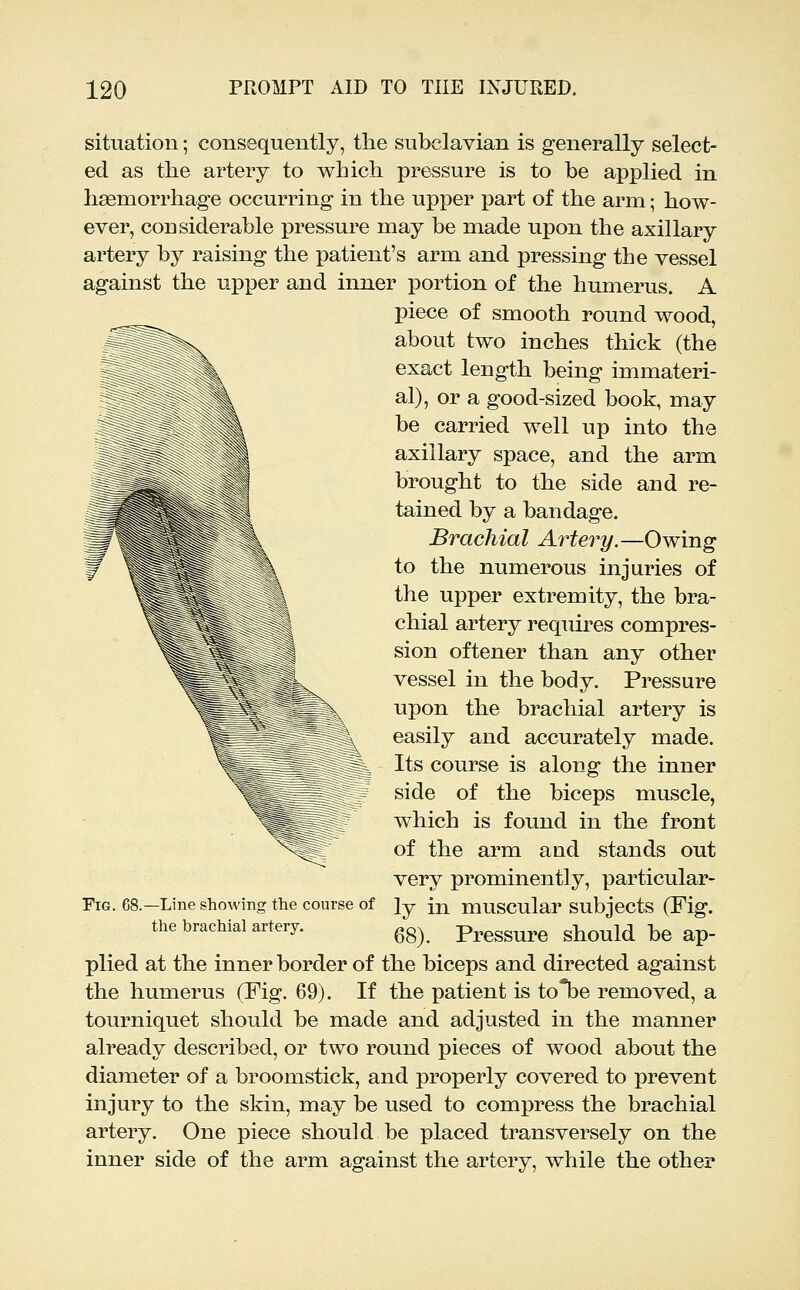 situation; consequently, the subclavian is generally select- ed as the artery to which pressure is to be applied in haemorrhage occurring in the upper part of the arm; how- ever, considerable pressure may be made upon the axillary artery by raising the patient's arm and pressing the vessel against the upper and inner portion of the humerus. A piece of smooth round wood, ^^^^\^ about two inches thick (the exact length being immateri- al), or a good-sized book, may be carried well up into the axillary space, and the arm brought to the side and re- tained by a bandage. Brachial Artej^y.—Owing to the numerous injuries of the upper extremity, the bra- chial artery requires compres- sion oftener than any other vessel in the body. Pressure upon the brachial artery is easily and accurately made. Its course is along the inner side of the biceps muscle, which is found in the front of the arm and stands out very prominently, particular- ly in muscular subjects (Fig. 68). Pressure should be ap- plied at the inner border of the biceps and directed against the humerus (Fig. 69). If the patient is to*be removed, a tourniquet should be made and adjusted in the manner already described, or two round pieces of wood about the diameter of a broomstick, and properly covered to prevent injury to the skin, may be used to compress the brachial artery. One piece should be placed transversely on the inner side of the arm against the artery, while the other Fig. 68.—Line showing the course of the brachial artery.