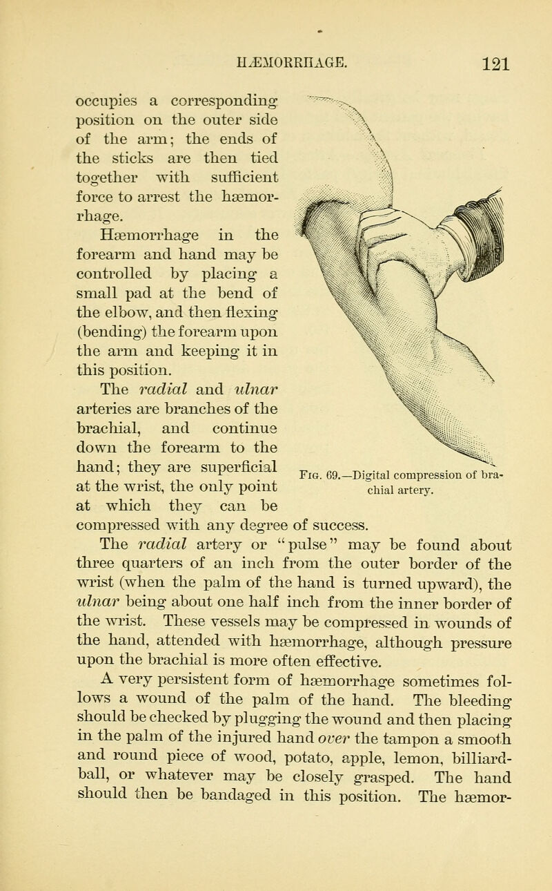 ^ \ r:^: occupies a corresponding position on the outer side of tlie arm; the ends of the sticks are then tied together with sufficient force to arrest the haemor- rhage. Haemorrhage in the forearm and hand may be controlled by placing a small pad at the bend of the elbow, and then flexing (bending) the forearm upon the arm and keeping it in this position. The radial and ulnar arteries are branches of the brachial, and continue down the forearm to the hand; they are superficial at the wrist, the only point at which they can be compressed with any degree of success. The radial artery or pulse may be found about three quarters of an inch from the outer border of the wrist (when the palm of the hand is turned upward), the ulnar being about one half inch from the inner border of the widst. These vessels may be compressed in wounds of the hand, attended with haemorrhage, although pressure upon the brachial is more often effective. A very persistent form of hemorrhage sometimes fol- lows a wound of the palm of the hand. The bleeding should be checked by plugging the wound and then placing in the palm of the injured hand over the tampon a smooth and round piece of wood, potato, apple, lemon, billiard- ball, or whatever may be closely grasped. The hand should then be bandaged in this position. The hsemor- FiG G9. -Digital compression of bra- chial artery.
