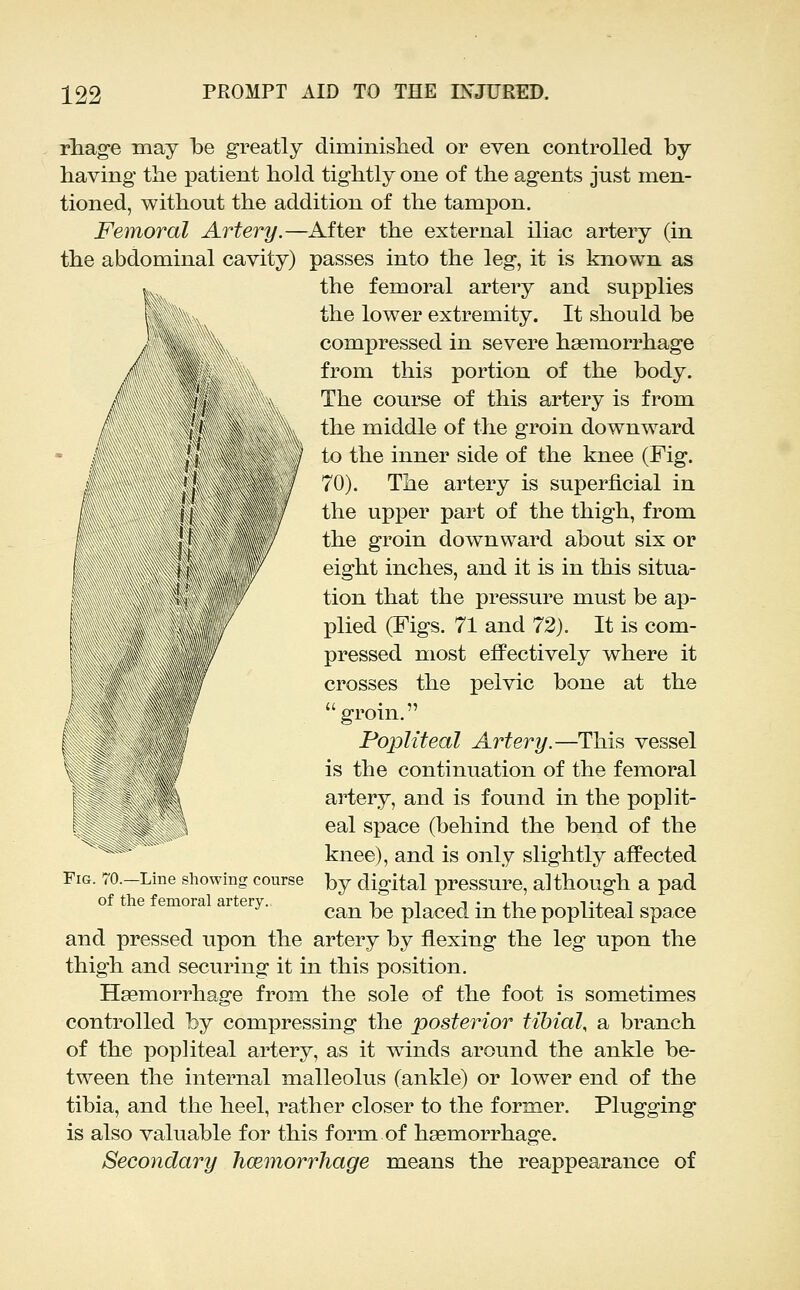 rhage may be greatly diminished or even controlled by having the patient hold tightly one of the agents just men- tioned, without the addition of the tampon. Femoral Artery.—After the external iliac artery (in the abdominal cavity) passes into the leg, it is known as the femoral artery and supplies the lower extremity. It should be compressed in severe haemorrhage from this portion of the body. The course of this artery is from the middle of the groin downward to the inner side of the knee (Fig. 70). The artery is superficial in the upper part of the thigh, from the groin downward about six or eight inches, and it is in this situa- tion that the pressure must be ap- plied (Figs. 71 and 72). It is com- pressed most efiPectively where it crosses the pelvic bone at the groin. Popliteal Artery.—This vessel is the continuation of the femoral artery, and is found in the poplit- eal space (behind the bend of the knee), and is only slightly affected by digital pressure, although a pad can be placed in the popliteal space and pressed upon the artery by flexing the leg upon the thigh and securing it in this position. Haemorrhage from the sole of the foot is sometimes controlled by compressing the posterior tibial, a branch of the popliteal artery, as it winds around the ankle be- tween the internal malleolus (ankle) or lower end of the tibia, and the heel, rather closer to the former. Plugging is also valuable for this form of haemorrhage. Secondary hcemorrhage means the reappearance of Fig. 70.—Line showing course of the femoral artery.