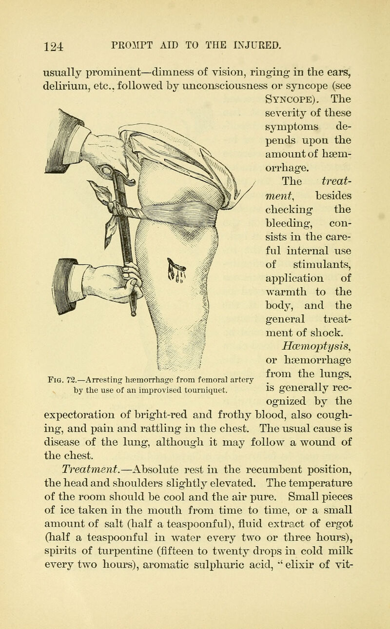 usually prominent—dimness of vision, ringing in the ears, delirium, etc., followed by unconsciousness or syncope (see Syncope). The severity of these symptoms de- pends upon the amount of haem- orrhage. The treat- ment, besides checking the bleeding, con- sists in the care- ful internal use of stimulants, application of warmth to the body, and the general treat- ment of shock. Hcemoptysis, or haemorrhage from the lungs, is generally rec- ognized by the expectoration of bright-red and frothy blood, also cough- ing, and pain and rattling in the chest. The usual cause is disease of the lung, although it may follow a woiuid of the chest. Treatment.—Absolute rest in the recumbent position, the head and shoulders slightly elevated. The temperature of the room should be cool and the air pure. Small pieces of ice taken in the mouth from time to time, or a small amount of salt (half a teaspoonful), fluid extract of ergot (half a teaspoonful in water every two or three hours), spirits of turpentine (fifteen to twenty drops in cold milk every two hours), aromatic sulphuric acid, '' elixir of vit- FiG. 72.—Arresting haemorrhage from femoral artery by the use of an improvised tourniquet.