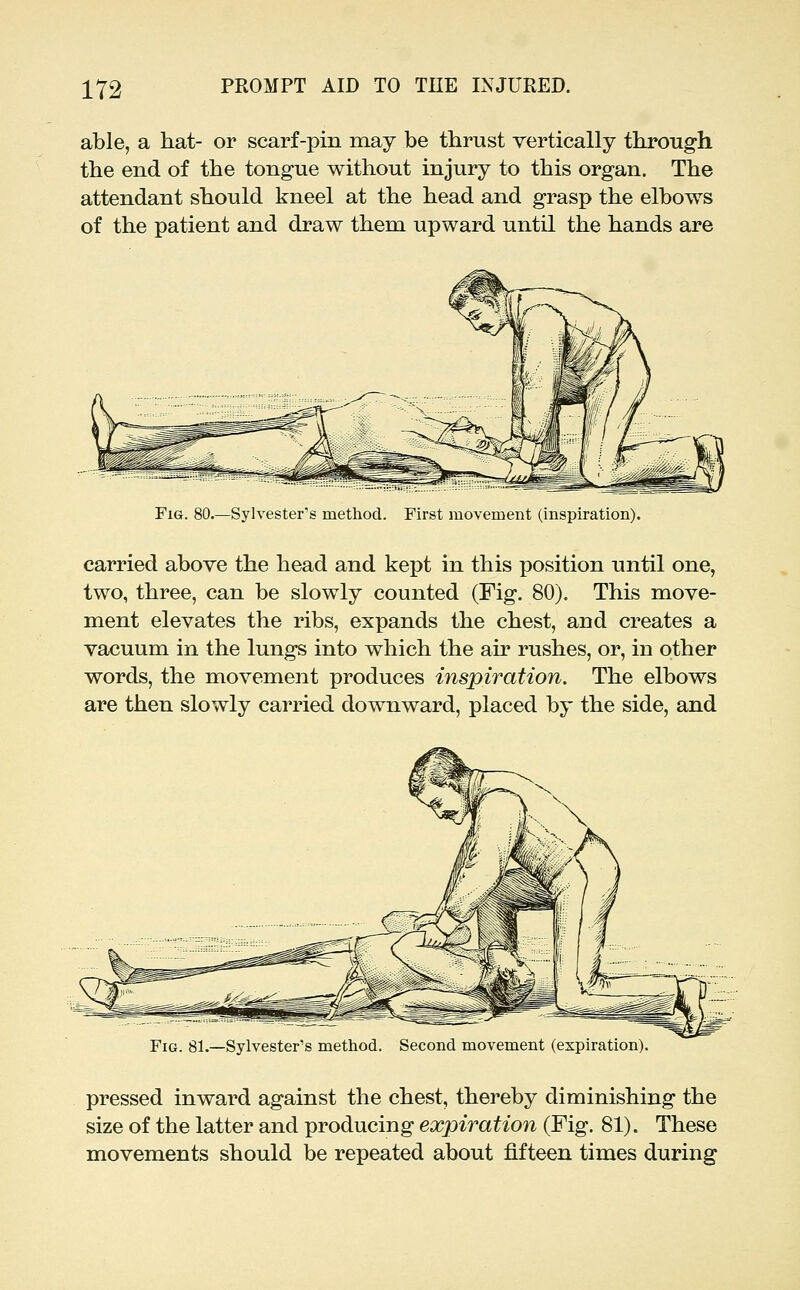 able, a hat- or scarf-pin may be thrust vertically through the end of the tongue without injury to this organ. The attendant should kneel at the head and grasp the elbows of the patient and draw them upward until the hands are FxG. 80.—Sylvester's method. First movement (inspiration). carried above the head and kept in this position until one, two, three, can be slowly counted (Fig. 80). This move- ment elevates the ribs, expands the chest, and creates a vacuum in the lungs into which the air rushes, or, in other words, the movement produces inspiration. The elbows are then slowly carried downward, placed by the side, and Fig. 81.—Sylvester's method. Second movement (expiration) pressed inward against the chest, thereby diminishing the size of the latter and producing expiration (Fig. 81). These movements should be repeated about fifteen times during