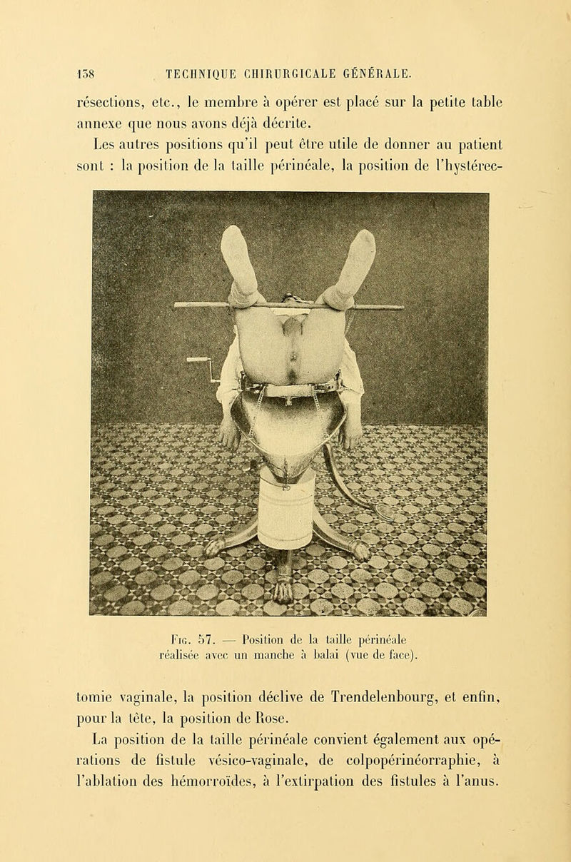 résections, etc., le membre à opérer est placé sur la petite table annexe que nous avons déjà décrite. Les autres positions qu'il peut être utile de donner au patient sont : la position de la taille périnéale, la position de l'hystérec- FiG. 57. — Position de lu taille périnéale réalisée avec un manche à balai (vue de face). tomie vaginale, la position déclive de Trendelenbourg, et enfin, pour la tête, la position de Rose. La position de la taille périnéale convient également aux opé- rations de fistule vésico-vaginale, de colpopérinéorraphie, à l'ablation des hémorroïdes, à l'extirpation des fistules à l'anus.