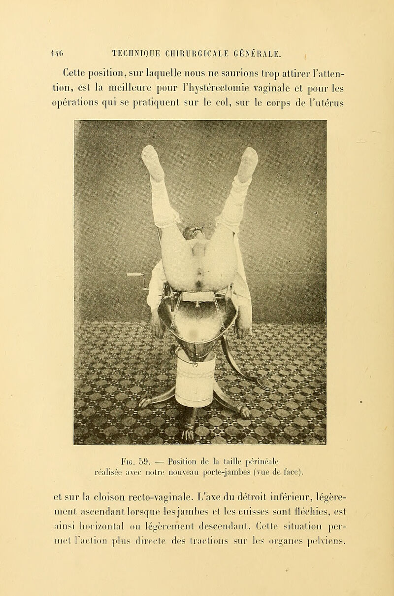 Cette position, sur laquelle nous ne saurions trop attirer l'allen- lion, est la meilleure pour l'hystéreclomie vaginale et pour les opérations qui se pratiquent sur le col, sur le corps de l'utérus FiG. 59. — Posilioii de la (aille périnéale réalisée avec notre nouveau porte-jambes (vue de face) et sur la cloison recto-vaginale. L'axe du détroit inférieur, légère- ment ascendant lorsque les jambes et les cuisses sont fléchies, est ainsi hofi/onlal mi légcrcmenl descendant. Co\lc situation per- nicl raclidii plus directe des tractions sur les oiganes pelviens.