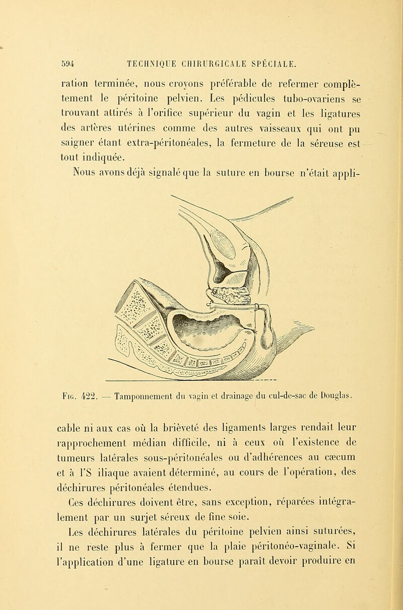 ration terminée, nous croyons préférable de refermer complè- tement le péritoine pelvien. Les pédicules tubo-ovariens se trouvant attirés à l'orifice supérieur du vagin et les ligatures des artères utérines comme des autres vaisseaux qui ont pu saigner étant extra-péritonéales, la fermeture de la séreuse est tout indiquée. Nous avons déjà signalé que la suture en bourse n'était appli- FiG. 422. — Tamponnement du vagin et drainage du cul-de-sac de Douglas. cable ni aux cas où la brièveté des ligaments larges rendait leur rapprochement médian difficile, ni à ceux où l'existence de tumeurs latérales sous-péritonéales ou d'adhérences au csecum et à rS iliaque avaient déterminé, au cours de l'opération, des déchirures péritonéales étendues. Ces déchirures doivent être, sans exception, réparées intégra- lement par un surjet séreux de fine soie. Les déchirures latérales du péritoine pelvien ainsi suturées, il ne reste plus à fermer que la plaie péritonéo-vaginale. Si l'application d'une ligature en bourse paraît devoir produire en