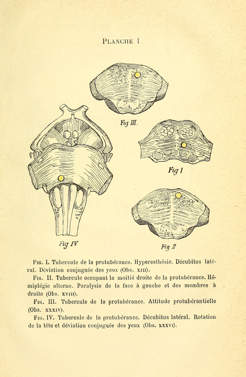 Fia IV Fi^ÏÏ FiG. I. Tubercule de la protubérance. Hyperesthésie. Décubitus laté- ral. Déviation conjuguée des yeux (Obs. xiii). FiG. IL Tubercule occupant la moitié droite de la protubérance. Hé- miplégie alterne. Paralysie de la face à gauche et des membres à droite (Obs. xviii). FiG. IIL Tubercule de la protubérance. Attitude protubérantielle (Obs. xxxiv). FiG. IV. Tubercule de la protubérance. Décubitus latéral. Rotation de la tête et déviation conjuguée des yeux (Obs. xxxvi).