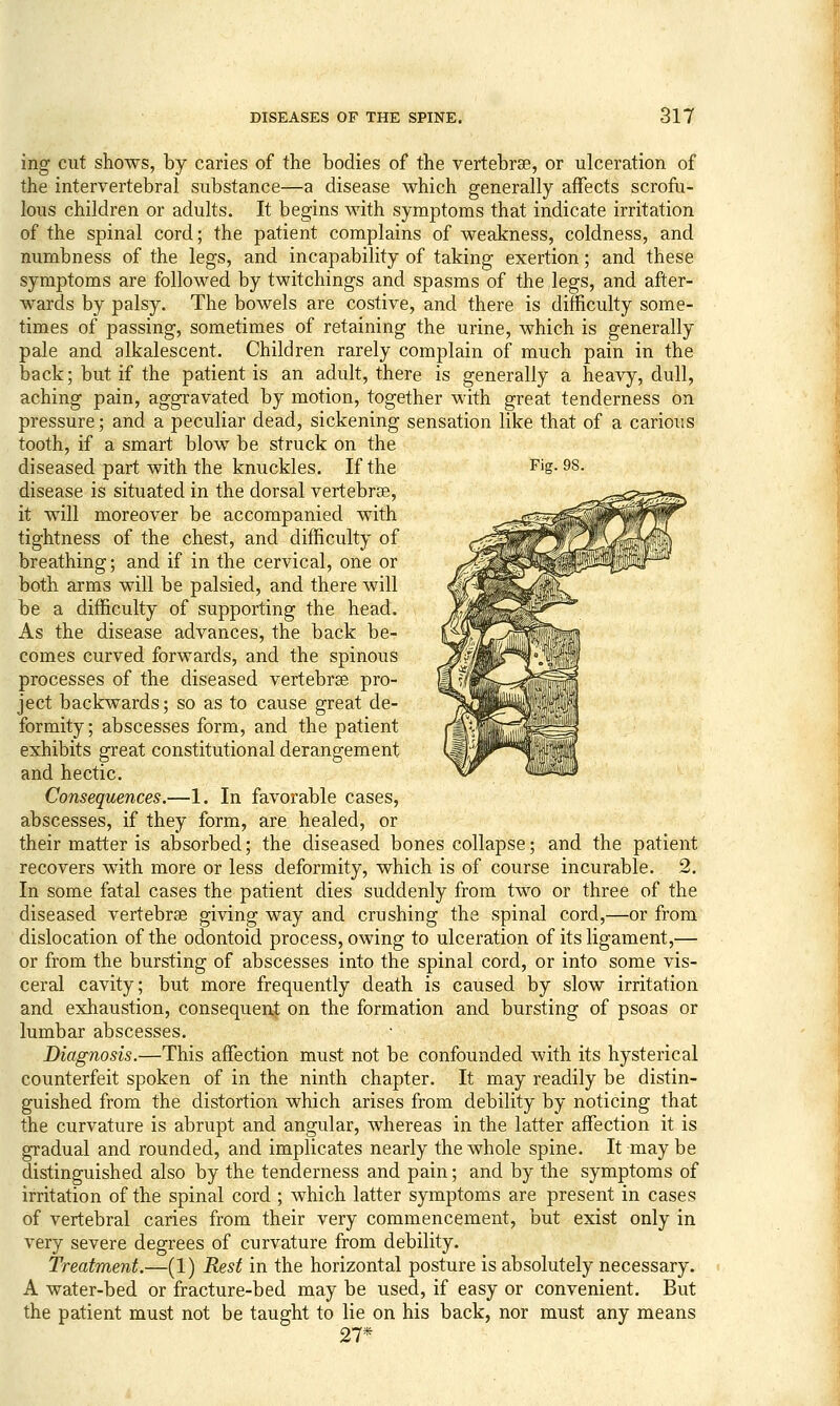 ing cut shows, by caries of the bodies of the vertebrse, or ulceration of the intervertebral substance—a disease which generally affects scrofu- lous children or adults. It begins with symptoms that indicate irritation of the spinal cord; the patient complains of weakness, coldness, and numbness of the legs, and incapability of taking exertion; and these symptoms are followed by twitchings and spasms of the legs, and after- wards by palsy. The bowels are costive, and there is difficulty some- times of passing, sometimes of retaining the urine, which is generally pale and alkalescent. Children rarely complain of much pain in the back; but if the patient is an adult, there is generally a heavy, dull, aching pain, aggravated by motion, together with great tenderness on pressure; and a peculiar dead, sickening sensation like that of a carious tooth, if a smart blow be struck on the diseased part with the knuckles. If the Fig. 98. disease is situated in the dorsal vertebrse, it will moreover be accompanied with tightness of the chest, and difficulty of breathing; and if in the cervical, one or both arms will be palsied, and there will be a difficulty of supporting the head. As the disease advances, the back be- comes curved forwards, and the spinous processes of the diseased vertebrse pro- ject backwards; so as to cause great de- formity; abscesses form, and the patient exhibits great constitutional derangement and hectic. Consequences.—1. In favorable cases, abscesses, if they form, are healed, or their matter is absorbed; the diseased bones collapse; and the patient recovers with more or less deformity, which is of course incurable. 2. In some fatal cases the patient dies suddenly from two or three of the diseased vertebrse giving way and crushing the spinal cord,—or from dislocation of the odontoid process, owing to ulceration of its ligament,— or from the bursting of abscesses into the spinal cord, or into some vis- ceral cavity; but more frequently death is caused by slow irritation and exhaustion, consequent on the formation and bursting of psoas or lumbar abscesses. Diagnosis.—This affection must not be confounded with its hysterical counterfeit spoken of in the ninth chapter. It may readily be distin- guished from the distortion which arises from debility by noticing that the curvature is abrupt and angular, whereas in the latter affection it is gradual and rounded, and implicates nearly the whole spine. It may be distinguished also by the tenderness and pain; and by the symptoms of irritation of the spinal cord ; which latter symptoms are present in cases of vertebral caries from their very commencement, but exist only in very severe degrees of curvature from debility. Treatment.—(1) Rest in the horizontal posture is absolutely necessary. A water-bed or fracture-bed may be used, if easy or convenient. But the patient must not be taught to lie on his back, nor must any means 27*