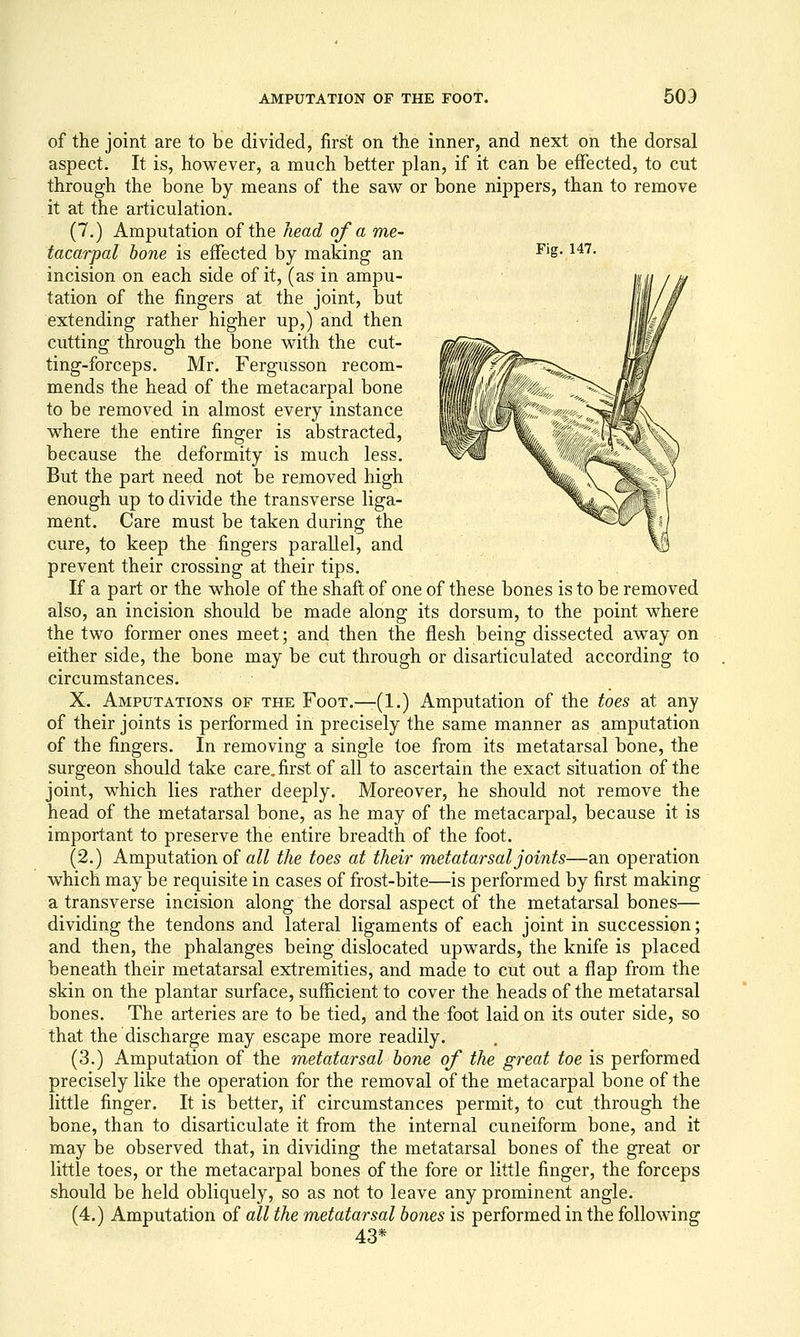 of the joint are to be divided, first on the inner, and next on the dorsal aspect. It is, however, a much better plan, if it can be effected, to cut through the bone by means of the saw or bone nippers, than to remove it at the articulation. (7.) Amputation of the head of a me- tacarpal hone is effected by making an ^'S- ^^'^• incision on each side of it, (as in ampu- tation of the fingers at the joint, but extending rather higher up,) and then cutting through the bone with the cut- ting-forceps. Mr. Fergusson recom- mends the head of the metacarpal bone to be removed in almost every instance where the entire finger is abstracted, because the deformity is much less. But the part need not be removed high enough up to divide the transverse liga- ment. Care must be taken during the cure, to keep the fingers parallel, and prevent their crossing at their tips. If a part or the whole of the shaft of one of these bones is to be removed also, an incision should be made along its dorsum, to the point where the two former ones meet; and then the flesh being dissected away on either side, the bone may be cut through or disarticulated according to circumstances. X. Amputations of the Foot.—(1.) Amputation of the toes at any of their joints is performed in precisely the same manner as amputation of the fingers. In removing a single toe from its metatarsal bone, the surgeon should take care, first of all to ascertain the exact situation of the joint, which lies rather deeply. Moreover, he should not remove the head of the metatarsal bone, as he may of the metacarpal, because it is important to preserve the entire breadth of the foot. (2.) Amputation of all the toes at their metatarsal joints—an operation which may be requisite in cases of frost-bite—is performed by first making a transverse incision along the dorsal aspect of the metatarsal bones— dividing the tendons and lateral ligaments of each joint in succession; and then, the phalanges being dislocated upwards, the knife is placed beneath their metatarsal extremities, and made to cut out a flap from the skin on the plantar surface, sufficient to cover the heads of the metatarsal bones. The arteries are to be tied, and the foot laid on its outer side, so that the discharge may escape more readily. (3.) Amputation of the metatarsal hone of the great toe is performed precisely like the operation for the removal of the metacarpal bone of the little finger. It is better, if circumstances permit, to cut through the bone, than to disarticulate it from the internal cuneiform bone, and it may be observed that, in dividing the metatarsal bones of the great or little toes, or the metacarpal bones of the fore or little finger, the forceps should be held obliquely, so as not to leave any prominent angle. (4.) Amputation of all the metatarsal hones is performed in the following 43*