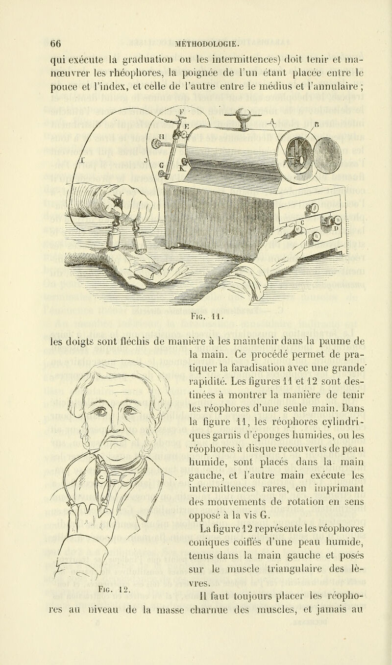 qui exécute la graduation ou les intermittences) doit tenir et ma- nœuvrer les rhéophores, la poignée de l'un étant placée entre le pouce et l'index, et celle de l'autre entre le médius et l'annulaire ; FiG. 11. les doigts sont fléchis de manière à les maintenir dans la paume de la main. Ce procédé permet de pra- tiquer la faradisation avec une grande' rapidité. Les figures 11 et 12 sont des- tinées à montrer la manière de tenir les réophores d'une seule main. Dans la figure 11, les réophores cylindri- ques garnis d'épongés humides, ou les réophores à disque recouverts de peau humide, sont placés dans la main gauche, et l'autre main exécute les intermittences rares, en imprimant des mouvements de rotation en sens opposé à la vis G. La figure 12 représente les réophores coniques coiffés d'une peau humide, tenus dans la main gauche et posés sur le muscle triangulaire des lè- vres. Il faut toujours placer les réopho- res au liiveau de la masse charnue des muscles, et jamais au