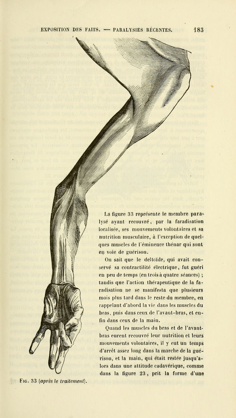 La figure 33 représente le membre para- lysé ayant recouvré, par la faradisation localisée, ses mouvements voloutaires et sa nutrition musculaire, à l'exception de quel- ques muscles de Téminence thénar qui sont en voie de guérison. On sait que le deltoïde, qui avait con- servé sa contractilité électrique, fut guéri en peu de temps (en trois à quatre séances) ; tandis que l'action thérapeutique de la fa- radisation ne se manifesta que plusieurs mois plus tard dans le reste du membre, en rappelant d'abord la vie dans les muscles du bras, puis dans ceux de l'avant-bras, et eu- fin dans ceux de la main. Quand les muscles du bras et de l'avant- bras eurent recouvré leur nutrition et leurs mouvements volontaires, il y eut un temps d'arrêt assez long dans la marche de la gué- rison, et la main, qui était restée jusqu'a- lors dans une attitude cadavérique, comme dans la figure 23, prit la forme d'une