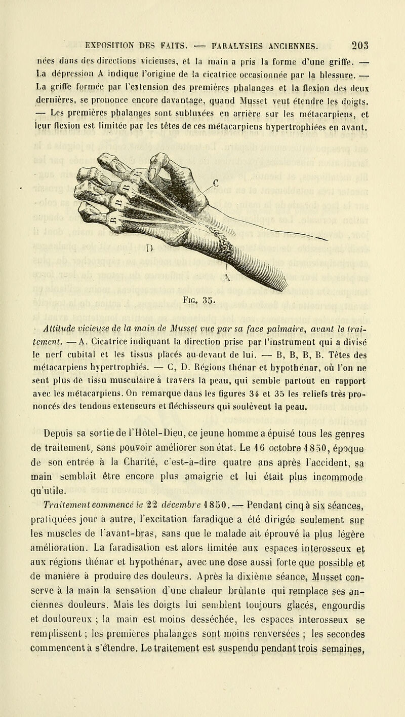 nées dans des directions vicieuses, et la main a pris la forme d'une grille. — La dépression A indique l'origine de la cicatrice occasionnée par la blessure. — La grille formée par l'extension des premières phalanges et la flexjon des deux dernières, se prononce encore davantage, quand Musset veut étendre les doigts. — Les premières phalanges sont subluxées en arrière sur les métacarpiens, et leur llexion est limitée par Jes têtes de ces métacarpiens hypertrophiées en avant. FiG. 35. Attitude vicieuse de la main de Musset vue par sa face palmaire, avant le trai- tement. — A. Cicatrice indiquant la direction prise par l'instrument qui a divisé le cerf cubital et les tissus placés au-devant de lui. — B, B, B, B. Têtes des métacarpiens hypertrophiés. — C, D. Régions thénar et hypothénar, où l'on ne sent plus de tissu musculaire à travers la peau, qui semble partout en rapport avec les métacarpiens. On remarque dans les figures 34 et 35 les reliefs très pro- noncés des tendons extenseurs et fléchisseurs qui soulèvent la peau. Depuis sa sortiederHôtel-Dieu,ce jeune homme a épuisé tous les genres de traitement, sans pouvoir améliorer son état. Le 16 octobre 4 850, époque de son entrée à la Charité, c'est-à-dire quatre ans après l'accident, sa main semblait être encore plus amaigrie et lui était plus inconamode qu'utile. Traitement commencé le 22 décembre 4 850. — Pendant cinq à sis séanceii, pratiquées jour à autre, l'excitation faradique a été dirigée seulement ^ur les muscles de Tavant-bras, sans que le malade ait éprouvé la plus légère amélioration. La faradisalion est alors limitée aux espaces interosseux et aux régions thénar et hypothénar, avec une dose aussi forte que possible et de manière à produire des douleurs. Après la dixième séance, Musset con- serve à la main la sensation d'une chaleur brûlante qui remplace ses an- ciennes douleurs. Mais les doigts lui semblent toujours glacés, engourdis et douloureux ; la main est moins desséchée, les espaces interosseux se remplissent ; les premières phalanges sont moins renversées ; les secondes commencent à s'élendre. Le traitement est suspendu pendant trois semaines,