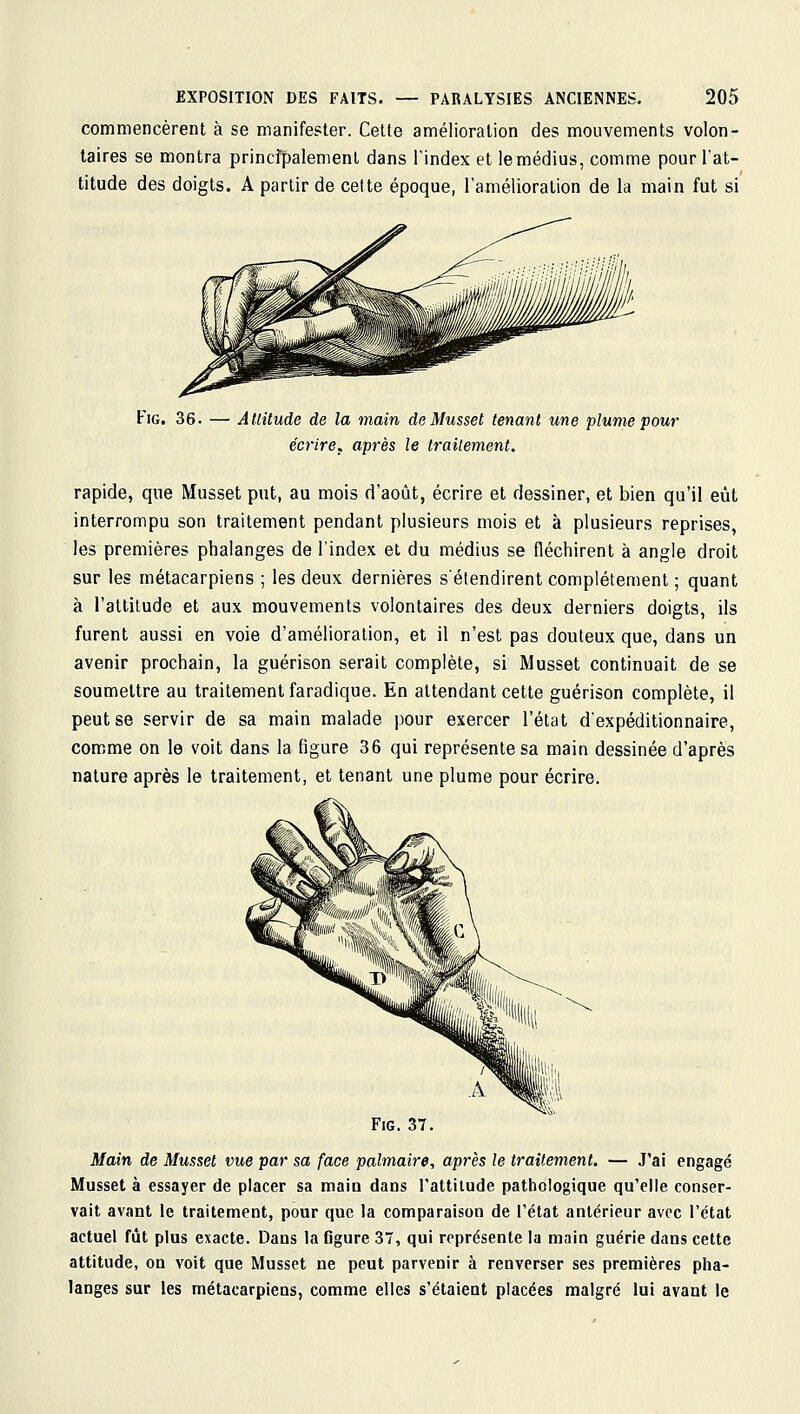 commencèrent à se manifester. Cette amélioration des mouvements volon- taires se montra principalement dans l'index et le médius, comme pour l'at- titude des doigts. A partir de cette époque, l'amélioration de la main fut si FiG. 36. — Attitude de la main de Musset tenant une plume pour écriref après le trailement. rapide, que Musset put, au mois d'août, écrire et dessiner, et bien qu'il eût interrompu son traitement pendant plusieurs mois et à plusieurs reprises, les premières phalanges de l'index et du médius se fléchirent à angle droit sur les métacarpiens ; les deux dernières s'étendirent complètement ; quant à l'attitude et aux mouvements volontaires des deux derniers doigts, ils furent aussi en voie d'amélioration, et il n'est pas douteux que, dans un avenir prochain, la guérison serait complète, si Musset continuait de se soumettre au traitement faradique. En attendant cette guérison complète, il peut se servir de sa main malade pour exercer l'état d'expéditionnaire, comme on le voit dans la figure 36 qui représente sa main dessinée d'après nature après le traitement, et tenant une plume pour écrire. FiG. 37. Main de Musset vue par sa face palmaire, après le traitement. — J'ai engagé Musset à essayer de placer sa main dans l'attilude pathologique qu'elle conser- vait avant le traitement, pour que la comparaison de l'état antérieur avec l'état actuel fût plus exacte. Dans la figure 37, qui représente la main guérie dans cette attitude, on voit que Musset ne peut parvenir à renverser ses premières pha- langes sur les métacarpiens, comme elles s'étaient placées malgré lui avant le