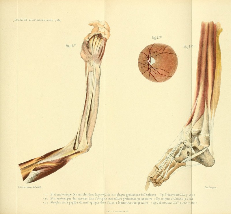 DUCEEl'ilfE, Slectrisationlocalisée . p, 286. V- -' \ 1 I Etat anatomique des muscles dans la paralysie atroplii(^ue graisseuse de l'enfance . I Yoy.l'observationXLII.p 2 ) Etat an atomique des muscles dans l's.tropliie musculaire sraisseuse prosressive . / Voj. autopsie de Lecomte.p. SoS