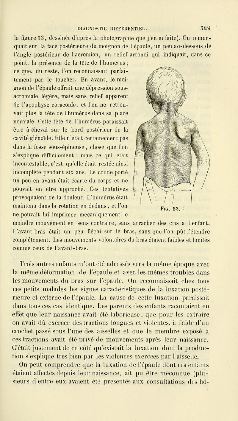 la figureSS, dessinée d'après la photographie que j'en ai faite). On remar- quait sur la face postérieure du moignon de l'épaule, un peu aa-dessous de l'angle postérieur de l'acromion, un relief arrondi qui indiquait, dans ce point, la présence de la tête de l'humérus; ce que, du reste, l'on reconnaissait parfai- tement par le toucher. En avant, le moi- gnon de l'épaule offrait une dépression sous- acromiale légère, mais sans relief apparent de l'apophyse coracoïde, et l'on ne retrou- vait plus la tête de l'humérus dans sa place normale. Cette tête de l'humérus paraissait être à cheval sur le bord postérieur de la cavité glénoïde. Elle n'était certainement pas dans la fosse sous-épineuse, chose que l'on s'explique difficilement : mais ce qui était incontestable, c'est qu'elle était restée ainsi incomplète pendant six ans. Le coude porté un peu en avant était écarté du corps et ne pouvait en être approché. Ces tentatives provoquaient de la douleur. L'humérus était maintenu dans la rotation en dedans, et l'on ne pouvait lui imprimer mécaniquement le moindre mouvement en sens contraire, sans arracher des cris à l'enfant. L'avant-bras était un peu fléchi sur le bras, sans que l'on pût l'étendre complètement. Les mouvements volontaires du bras étaient faibles et limités comme ceux de l'avant-bras. Trois autres enfants m'ont été adressés vers la même époque avec la même déformation de l'épaule et avec les mêmes troubles dans les mouvements du bras sur l'épaule. On reconnaissait chez tous ces petits malades les signes caractéristiques de la luxation posté- rieure et externe de l'épaule, La cause de cette luxation paraissait dans tous ces cas identique. Les parents des enfants racontaient en effet que leur naissance avait été laborieuse; que pour les extraire on avait dû exercer des tractions longues et violentes, à l'aide d'un crochet passé sous l'une des aisselles et que le membre exposé à ces tractions avait été privé de mouvements après leur naissance. C'était justement de ce côté qu'existait la luxation dont la produc- tion s'explique très bien par les violences exercées par l'aisselle. On peut comprendre que la luxation de l'épaule dont ces enfants étaient affectés depuis leur naissance, ait pu être méconnue (plu- sieurs d'entre eux avaient été présentés aux consultations des hô-