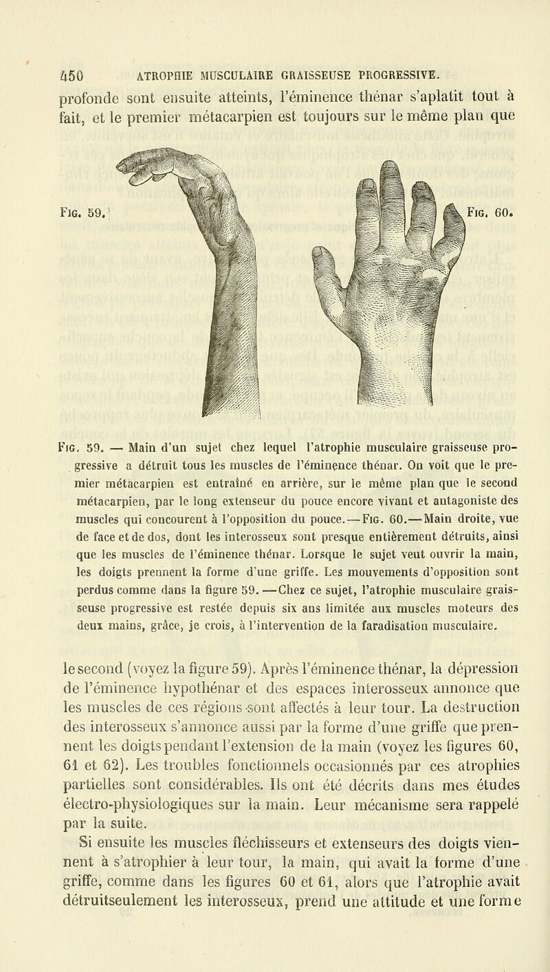 profonde sont eîisuite atteints, l'éminence thénar s'aplatit tout à fait, et le premier métacarpien est toujours sur le même plan que 4. FlG. 59.' 4 FiG. 60. FiG. 59. — Main d'un sujet chez lequel l'atrophie musculaire graisseuse pro- gressive a détruit tous les muscles de rémiaçnce thénar. On voit que le pre- mier métacarpien est entraîné en arrière, sur îe même plan que le second métacarpien, par le long extenseur du pouce encore vivant et antagoniste des muscles qui concourent à l'opposition du pouce. — Fig. 60.—Main droite, vue de face et de dos, dont les interosseus sont presque entièrement déti'uits, ainsi que les muscles de l'éminence thénar. Lorsque le sujet veut ouvrir la main, les doigts prennent la forme d'une griffe. Les mouvements d'opposition sont perdus comme dans la figure 59. —Chez ce sujet, l'atrophie musculaire grais- seuse progressive est restée depuis six ans limitée aux muscles moteurs des deux mains, grâce, je crois, à l'intervention de la faradisation musculaire. le second (voyez la figure 59). Après l'éminence thénar, la dépression de l'éminence hypothénar et des espaces interosseux annonce que les muscles de ces régions-sont affectés à leur tour. La destruction des interosseux s'annonce aussi par la forme d'une griffe que pren- nent les doigts pendant l'extension de la main (voyez les figures 60, 61 et 62). Les troubles fonctionnels occasionnés par ces atrophies partielles sont considérables. Ils ont été décrits dans mes études électro-physiologiques sur ia main. Leur mécanisme sera rappelé par la suite. Si ensuite les muscles fléchisseurs et extenseurs des doigts vien- nent à s'atrophier à leur tour, la main, qui avait la forme d'une griffe, comme dans les figures 60 et 61, alors que l'atrophie avait détruitseulement les interosseus, prend une attitude et une forme