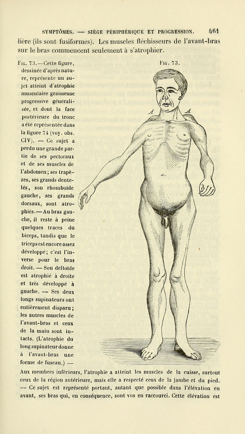 lière (ils sont fusiformes). Les muscles fléchisseurs de l'avant-bras sur le bras commencent seulement à s'atrophier. FiG. 73.—Cette figure, dessinée d'après natu- re, représente un su- jet atteint d'atrophie musculaire graisseuse progressive générali- sée, et dont la face postérieure du tronc a été représentée dans la figure 74 (voy. obs. CIV). — Ce sujet a perdu une grande par- tie de ses pectoraux et de ses muscles de l'abdomen; ses trapè- zes, ses grands dente- lés , son rhomboïde gauche, ses grands dorsaux, sont atro- phiés.—Au bras gau- che, il reste à peine quelques traces du biceps, tandis que le triceps est encore assez développé; c'est l'in- verse pour le bras droit. — Son deltoïde est atrophié à droite et très développé à gauche. — Ses deux longs supinateursont [ entièrement disparu ; les autres muscles de l'avant-bras et ceux de la maiu sont in- tacts. (L'atrophie du longsupinateur donne à l'avant-bras une forme de fuseau.) — Aux membres inférieurs, l'atrophie a atteint les muscles de la cuisse, surtout ceux de la région antérieure, mais elle a respecté ceux de la jambe et du pied. — Ce sujet est représenté portant, autant que possible dans l'élévation en avant, ses bras qui, en conséquence, sont vus en raccourci. Cette élévation est