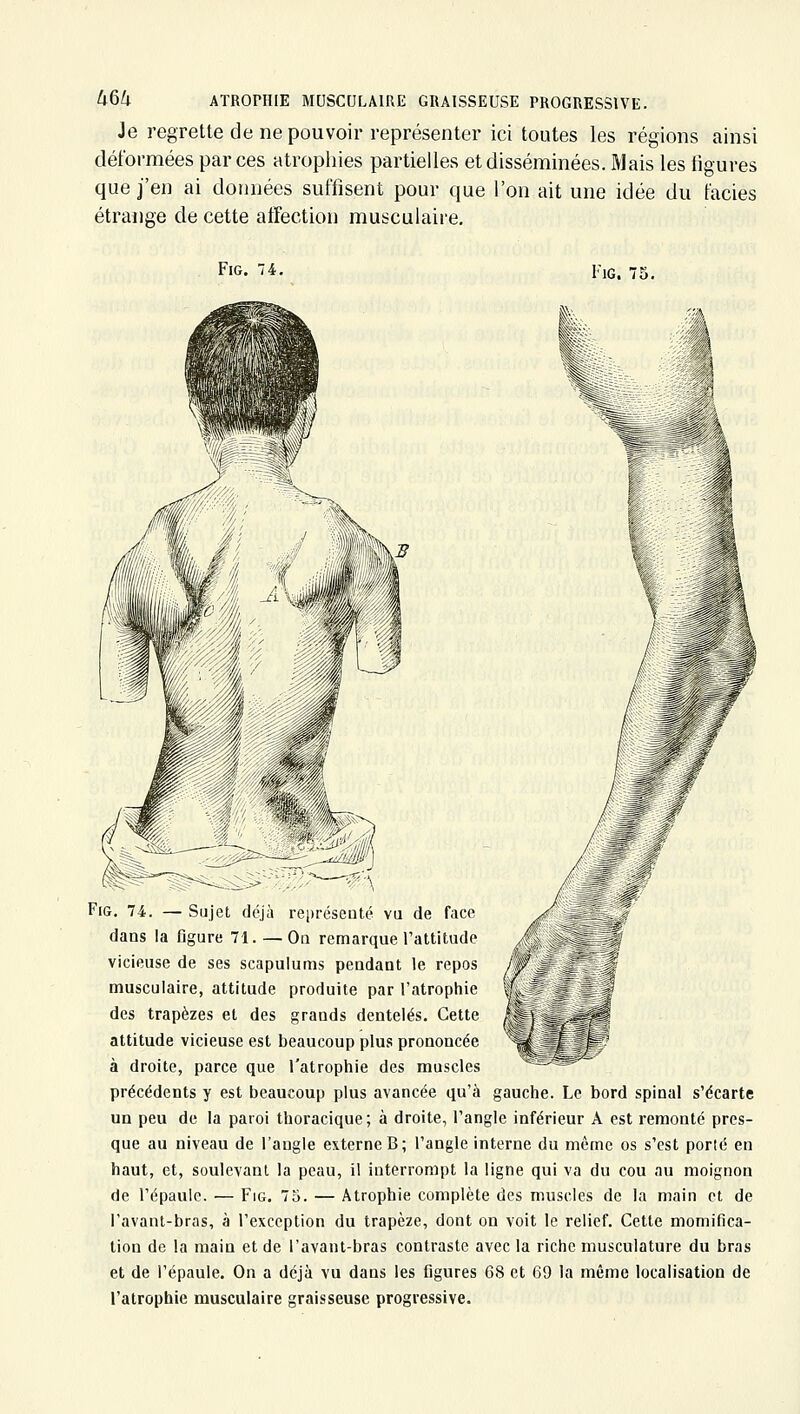 Je regrette de ne pouvoir représenter ici toutes les régions ainsi déformées parées atropines partielles et disséminées. Mais les ligures que j'en ai données suffisent pour que l'on ait une idée du faciès étrange de cette affection musculaire. FiG. 74. FlG. FiG. 74. —Sujet deja lepiescQte vu de face dans la figure 71. — Oa remarque l'attitude vicieuse de ses scapulums peudant le repos musculaire, attitude produite par l'atrophie des trapèzes et des grands dentelés. Cette attitude vicieuse est beaucoup plus prononcée à droite, parce que l'atrophie des muscles précédents y est beaucoup plus avancée qu'à un peu de la paroi thoracique; à droite, l'angle inférieur A est remonté pres- que au niveau de l'angle externe B; l'angle interne du même os s'est porté en haut, et, soulevanl la peau, il interrompt la ligne qui va du cou au moignon de l'épaule. — Fig. 73. — Atrophie complète des muscles de la main et de l'avant-bras, à l'exception du trapèze, dont on voit le relief. Cette momifica- tion de la main et de l'avant-bras contraste avec la riche musculature du bras et de l'épaule. On a déjà vu dans les figures 68 et 69 la même localisation de l'atrophie musculaire graisseuse progressive. ?auche. Le bord spinal s'écarte